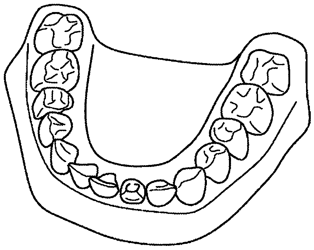 Virtual model of articulation from intra-oral scans