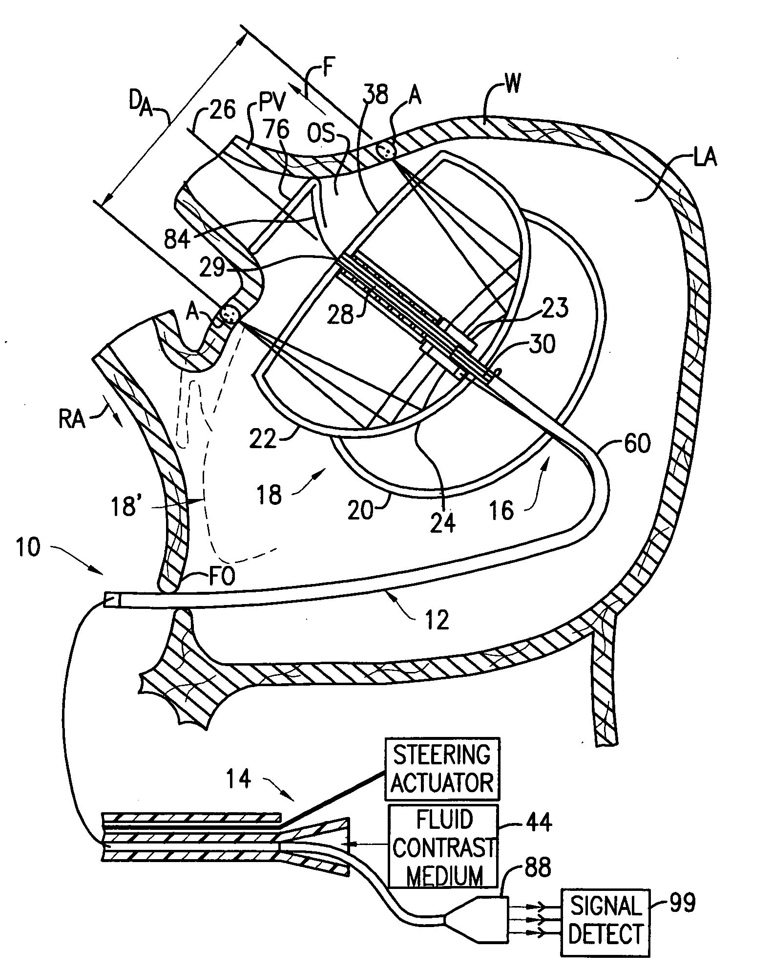 Miniature circular mapping catheter