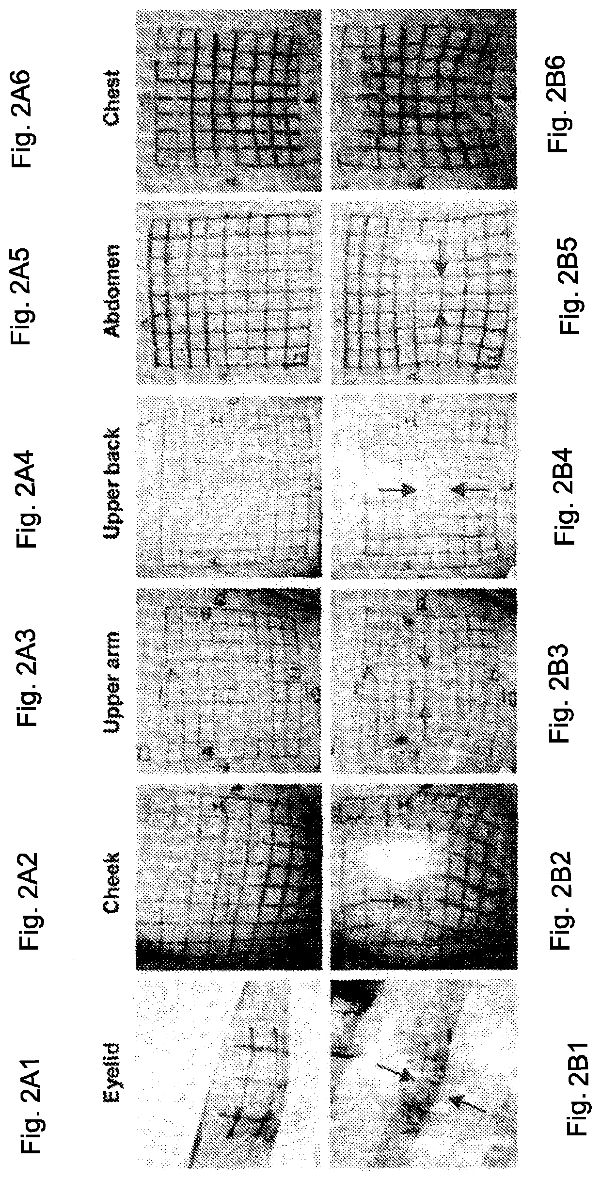 Elastic devices, methods, systems and kits for selecting skin treatment devices