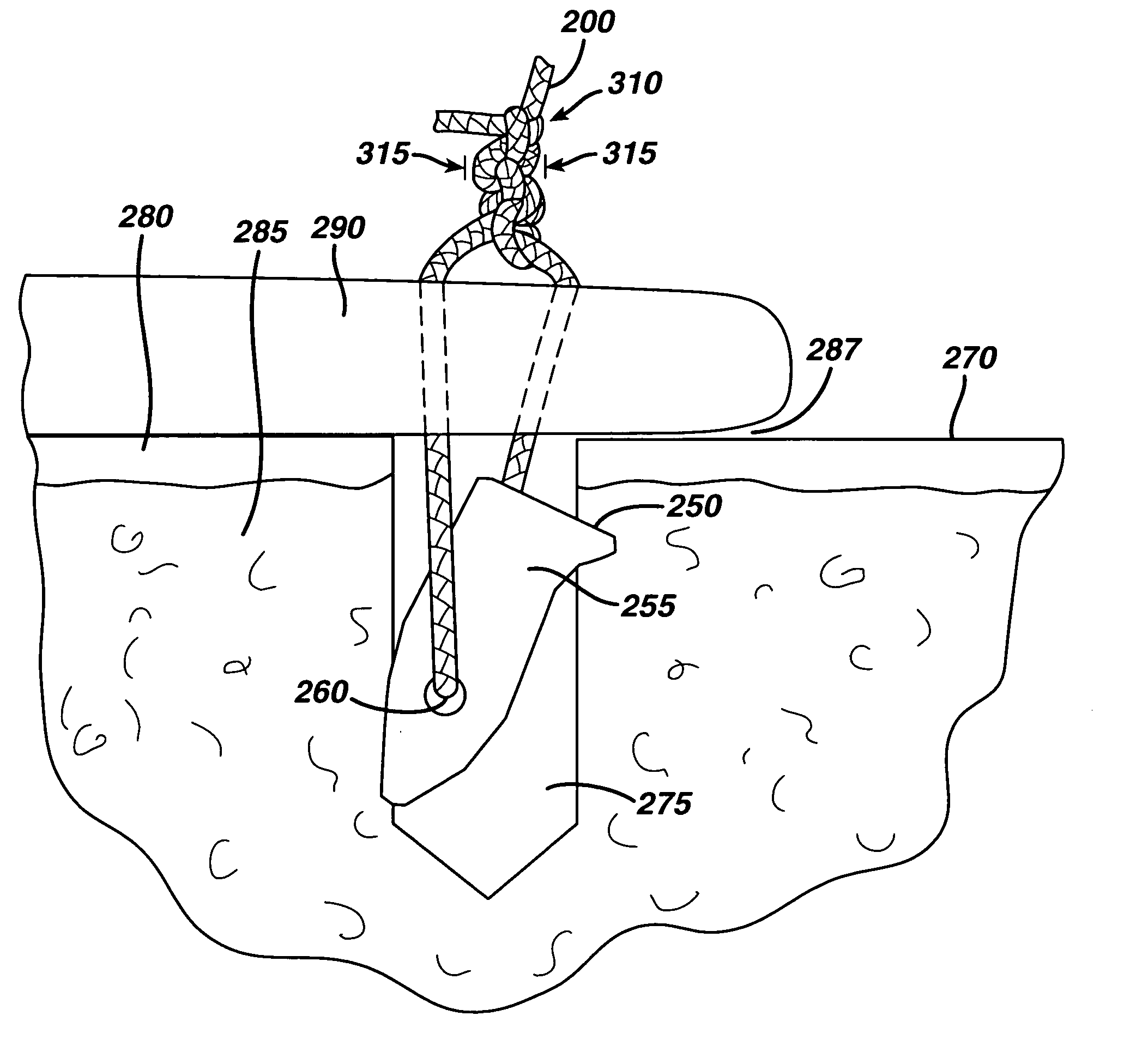 High strength suture with absorbable core and suture anchor combination