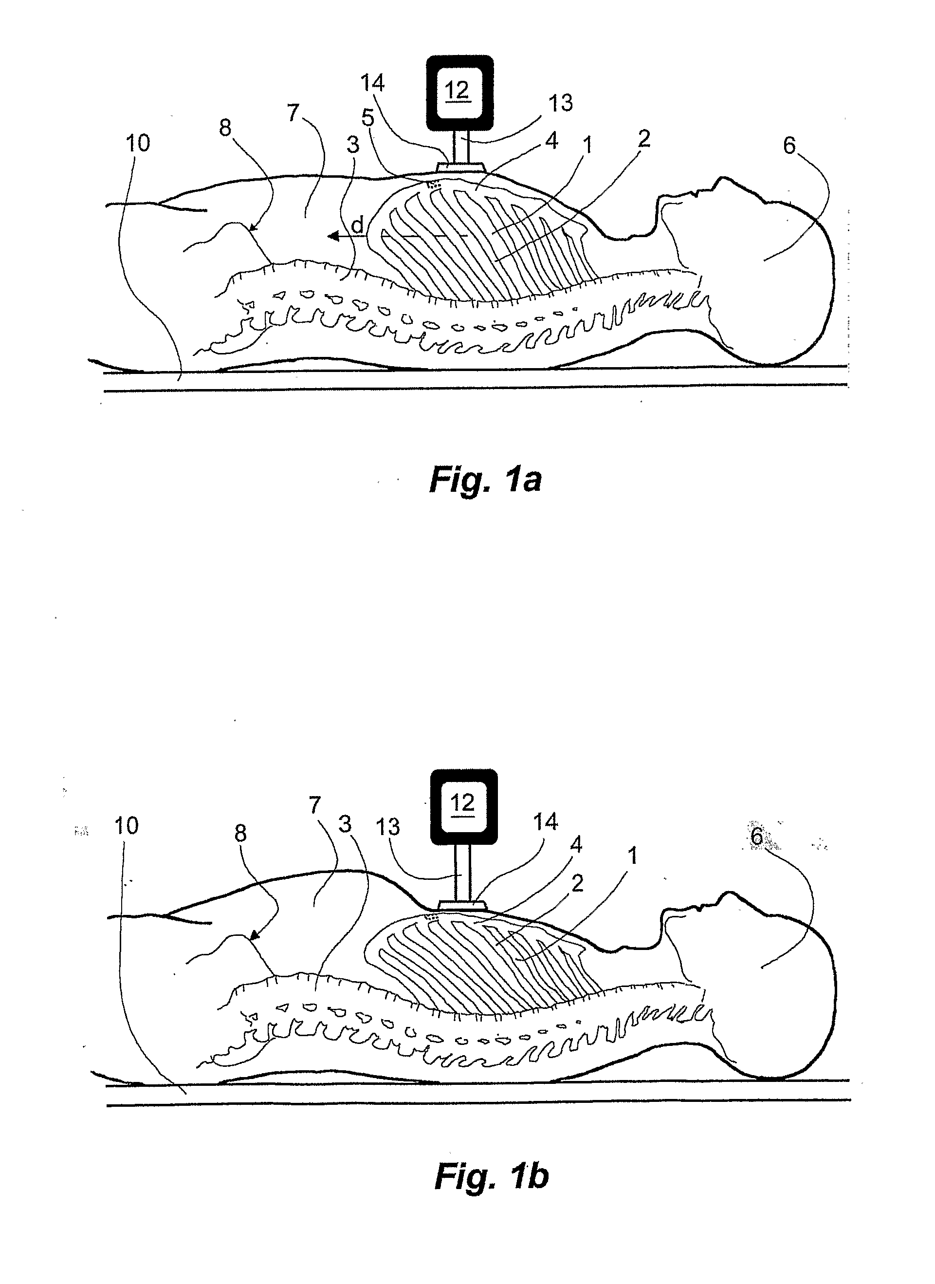  method and a device for abdominally stabilizing patient