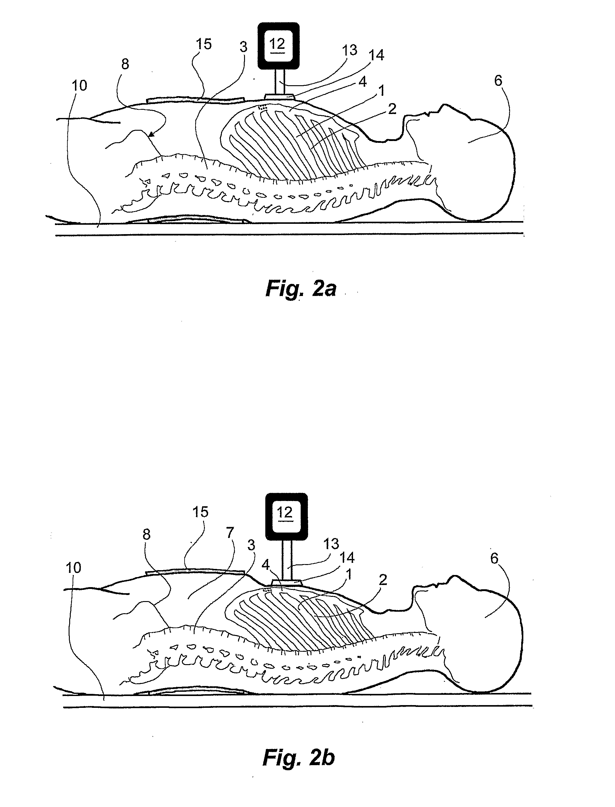  method and a device for abdominally stabilizing patient