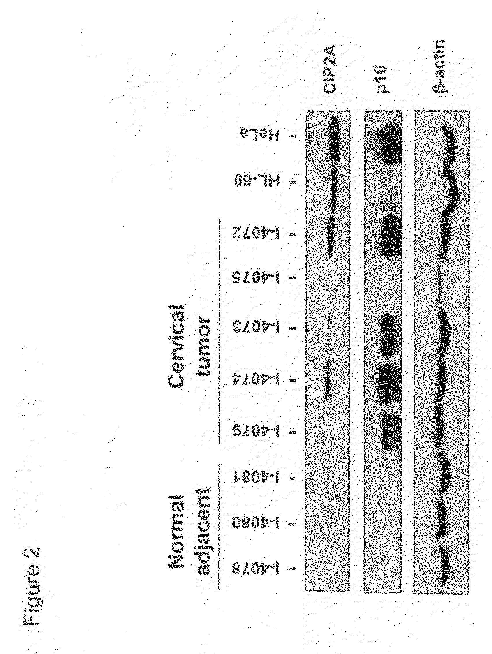 CIP2A as a biomarker in detection of cervical cancer