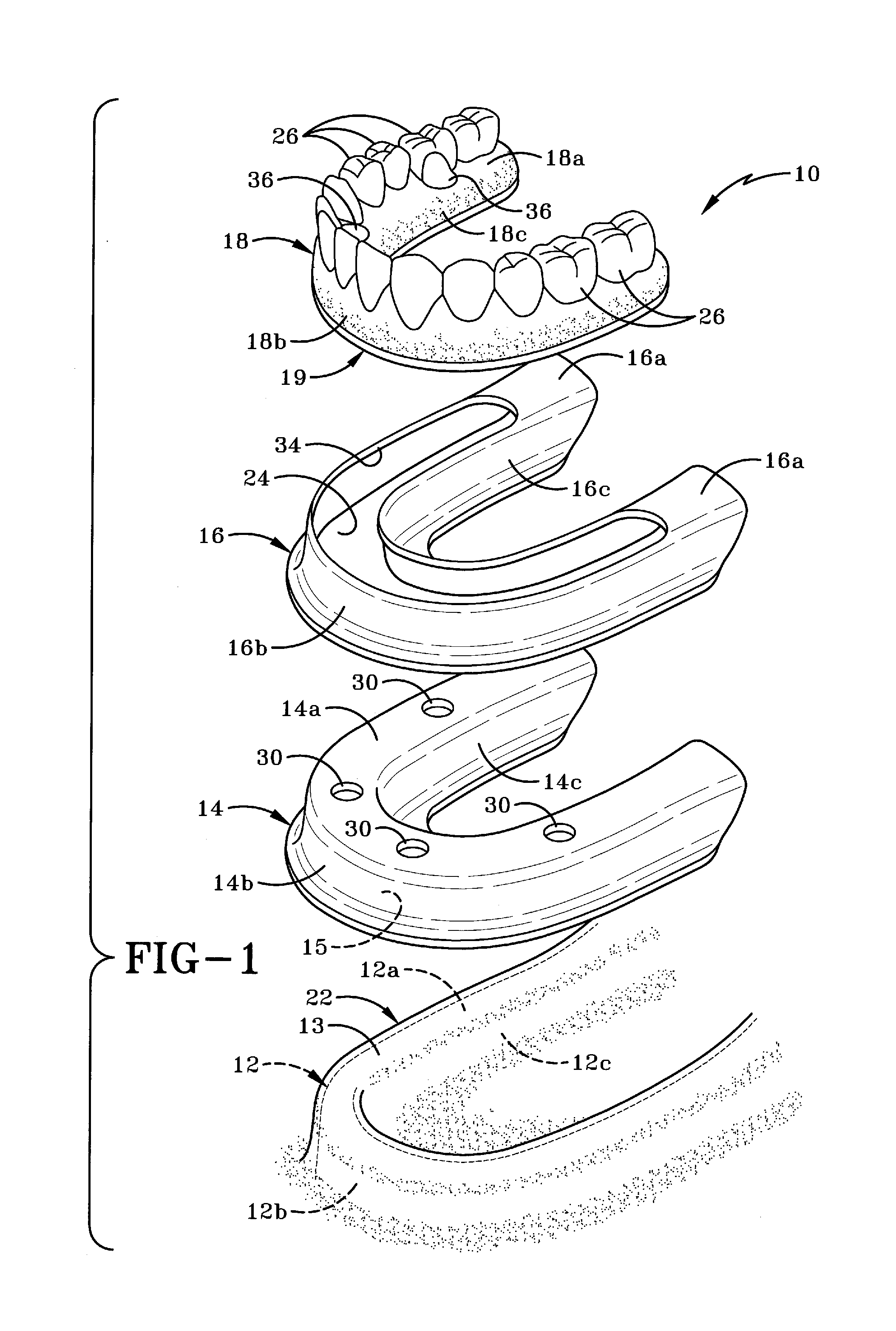 Method of installing a final dental prosthesis