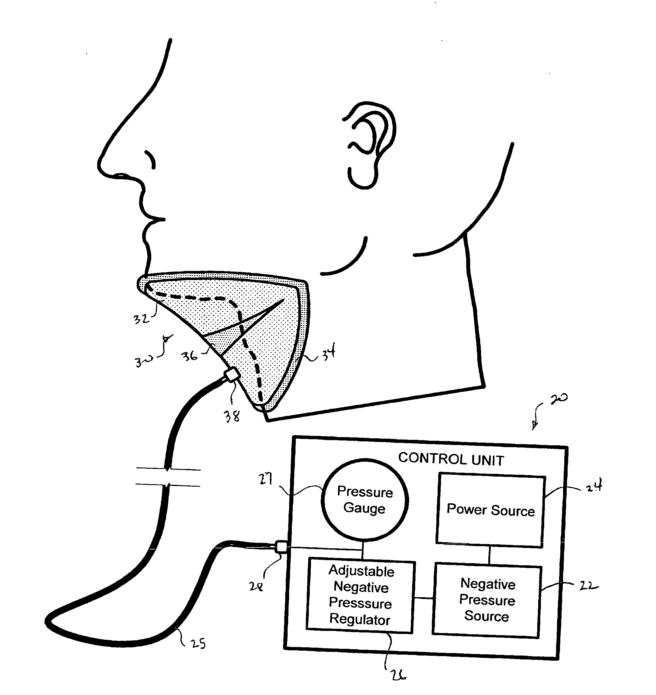 Devices and methods for treating sleep disorders