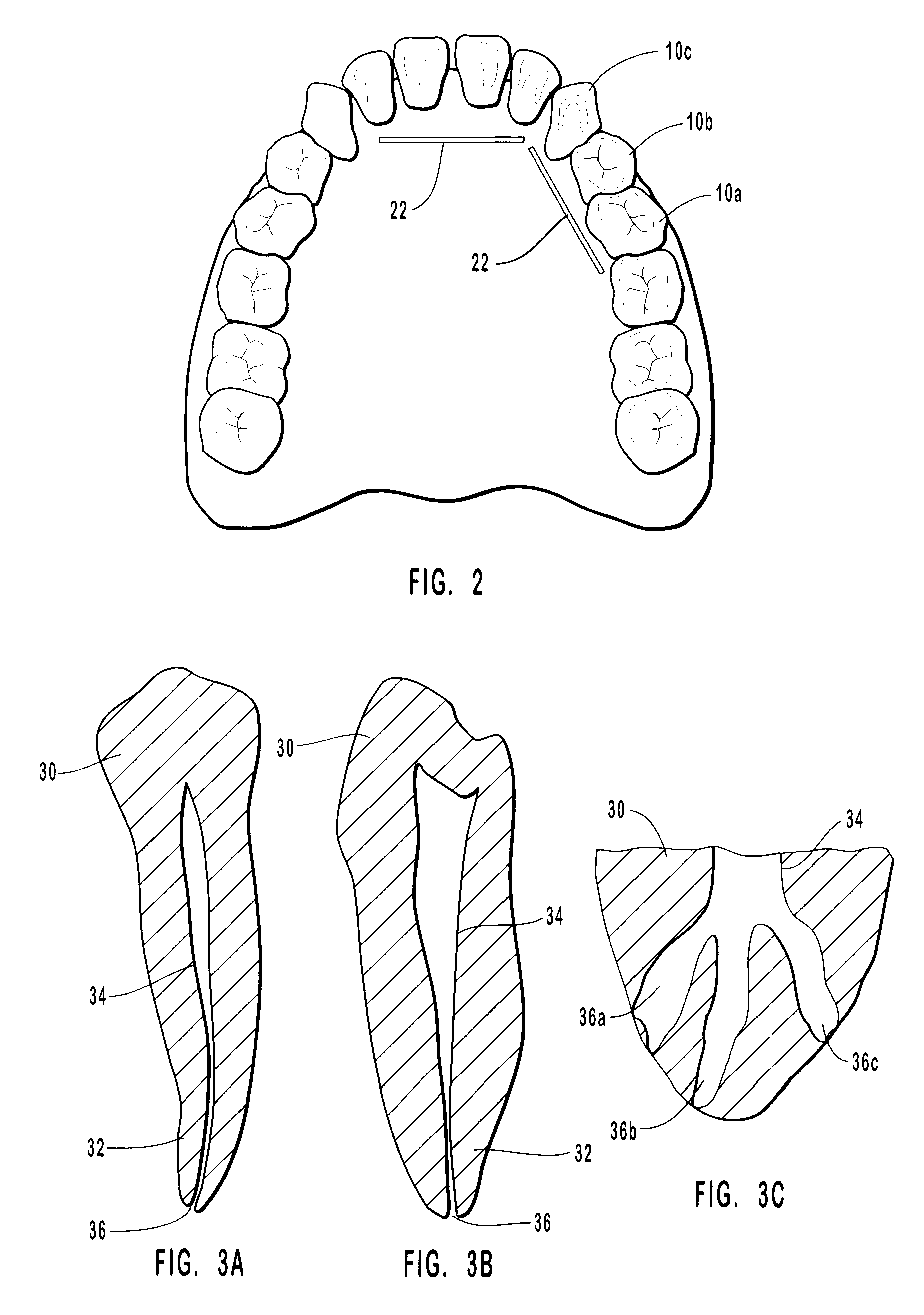 Endodontic systems and methods for the anatomical, sectional and progressive corono-apical preparation of root canals with dedicated stainless steel instruments and dedicated nickel/titanium instruments