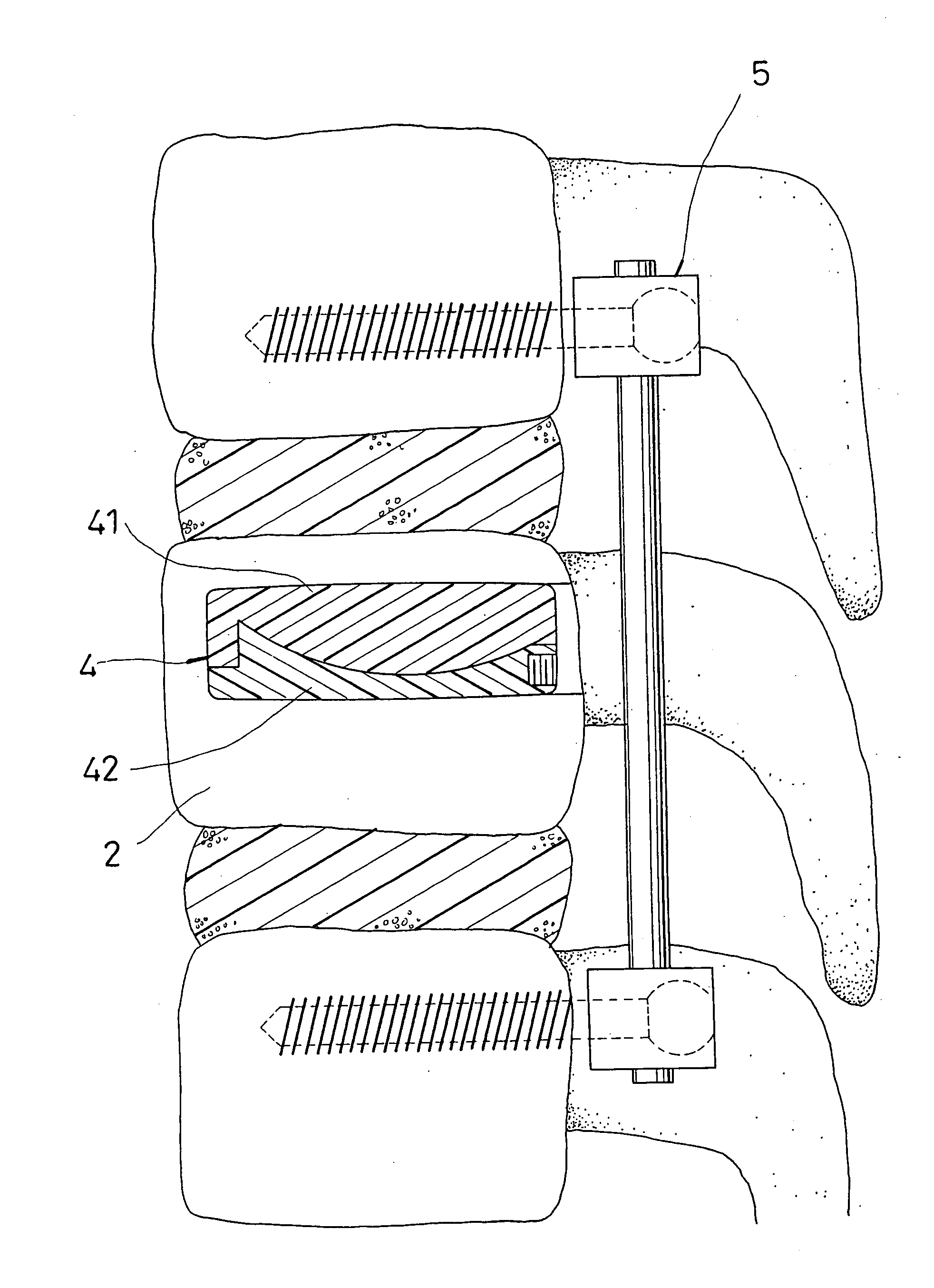 Method for fixing an augmenter for vertebral body reconstruction