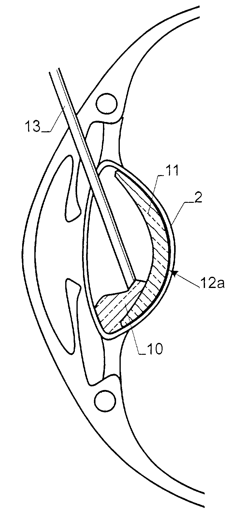 Lens implant