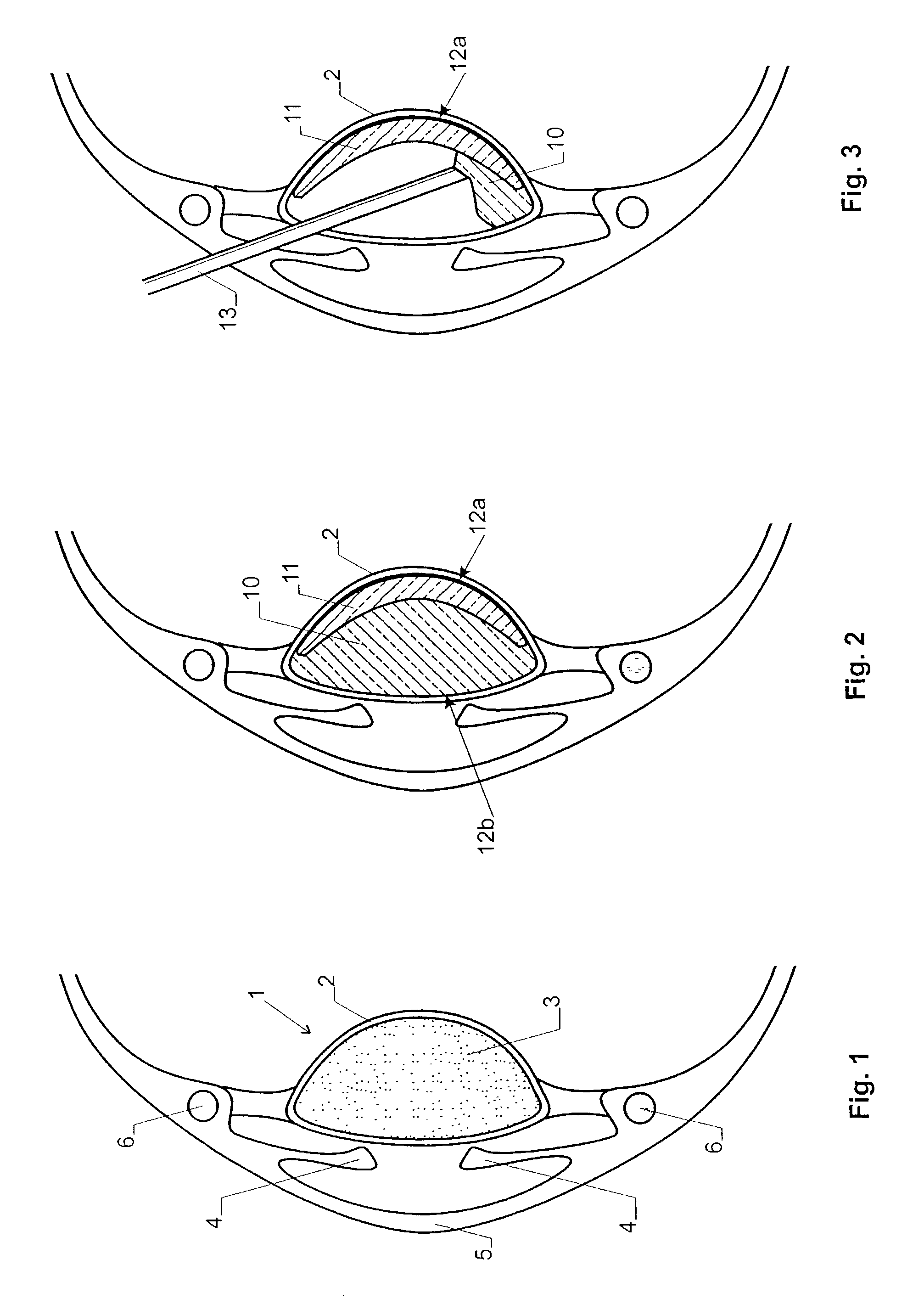 Lens implant