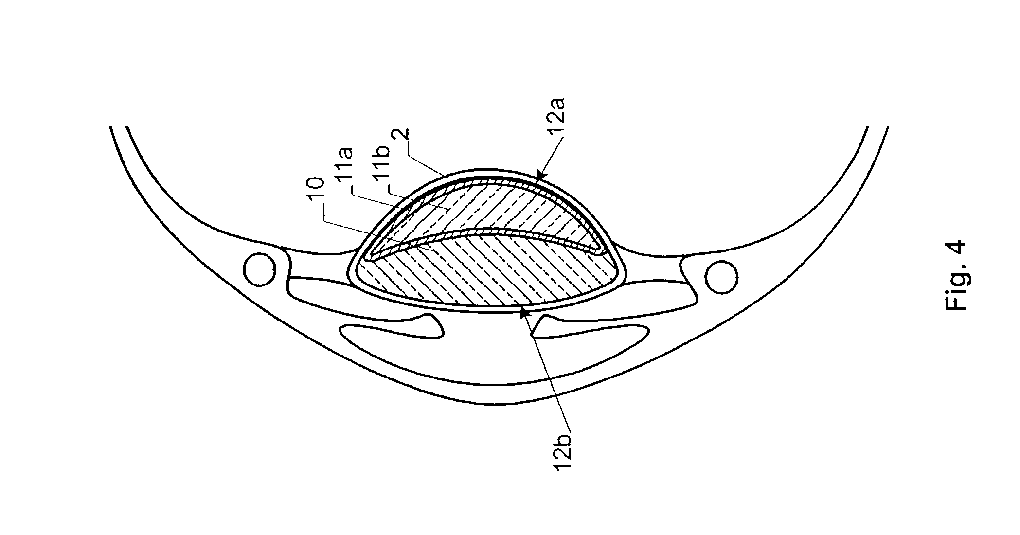 Lens implant