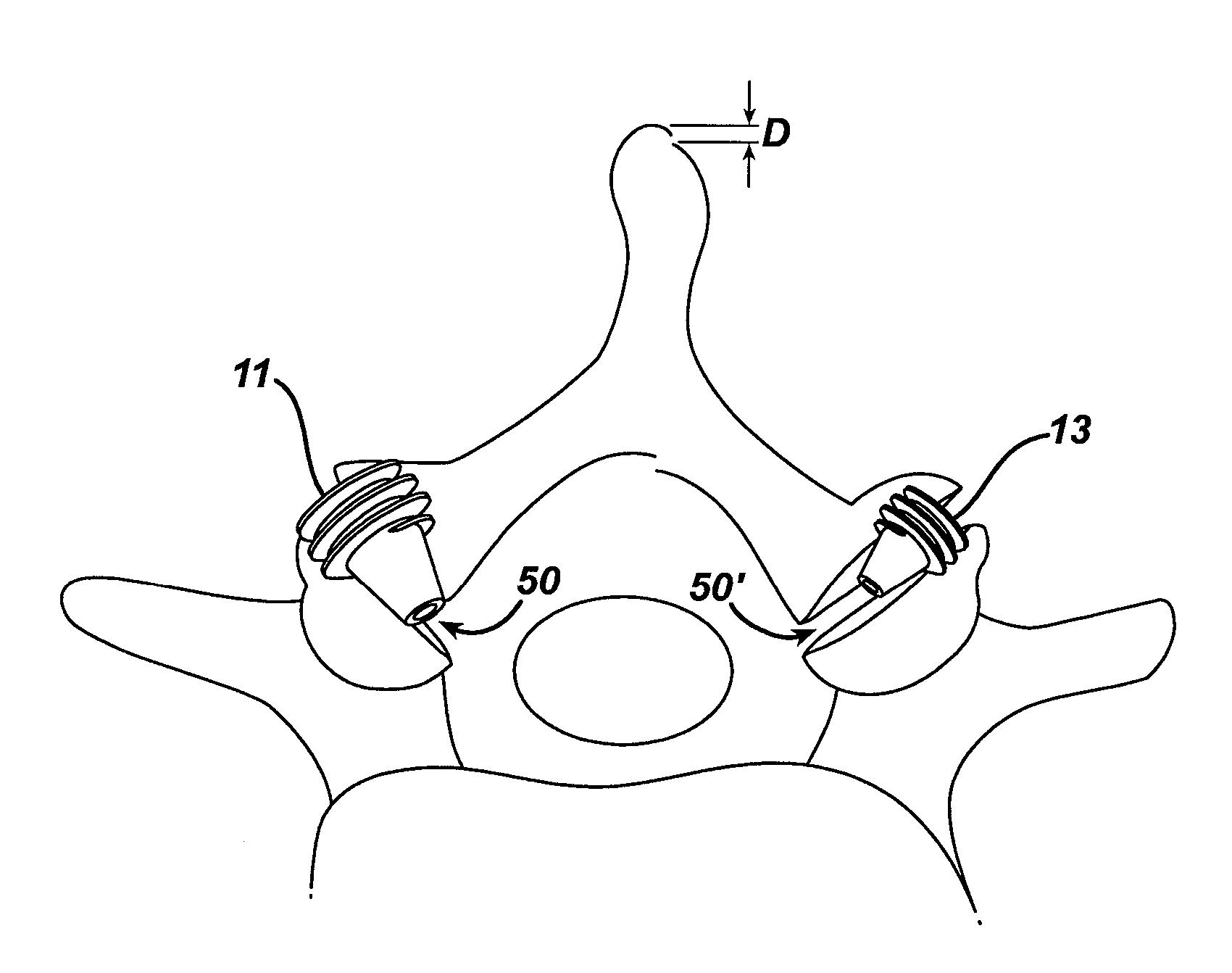 Intra-facet fixation device and method of use