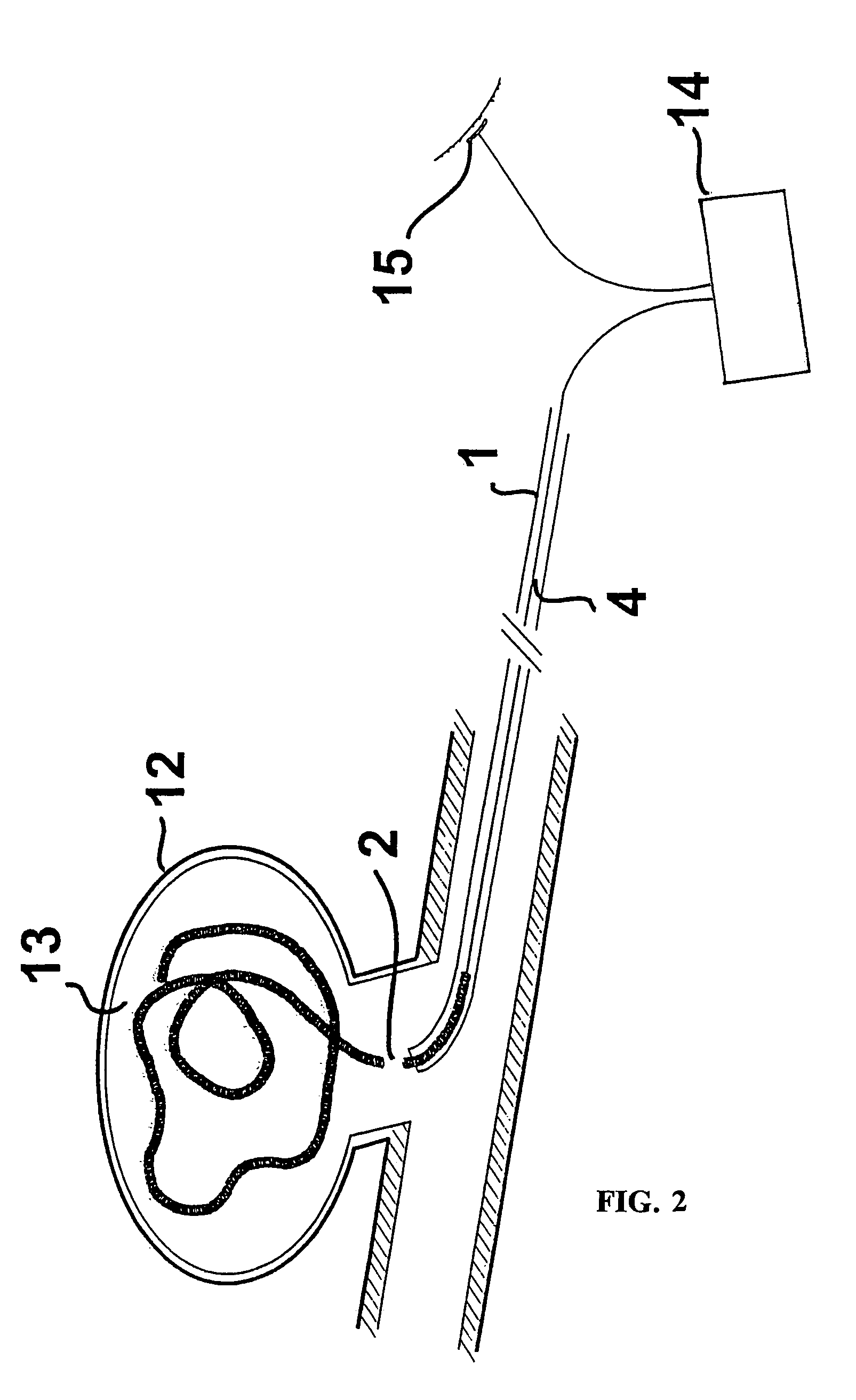 Device for implanting occlusion spirals