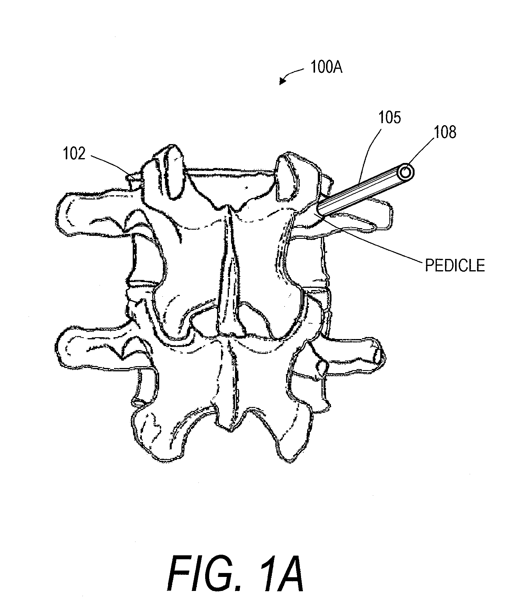 Systems for treating bone