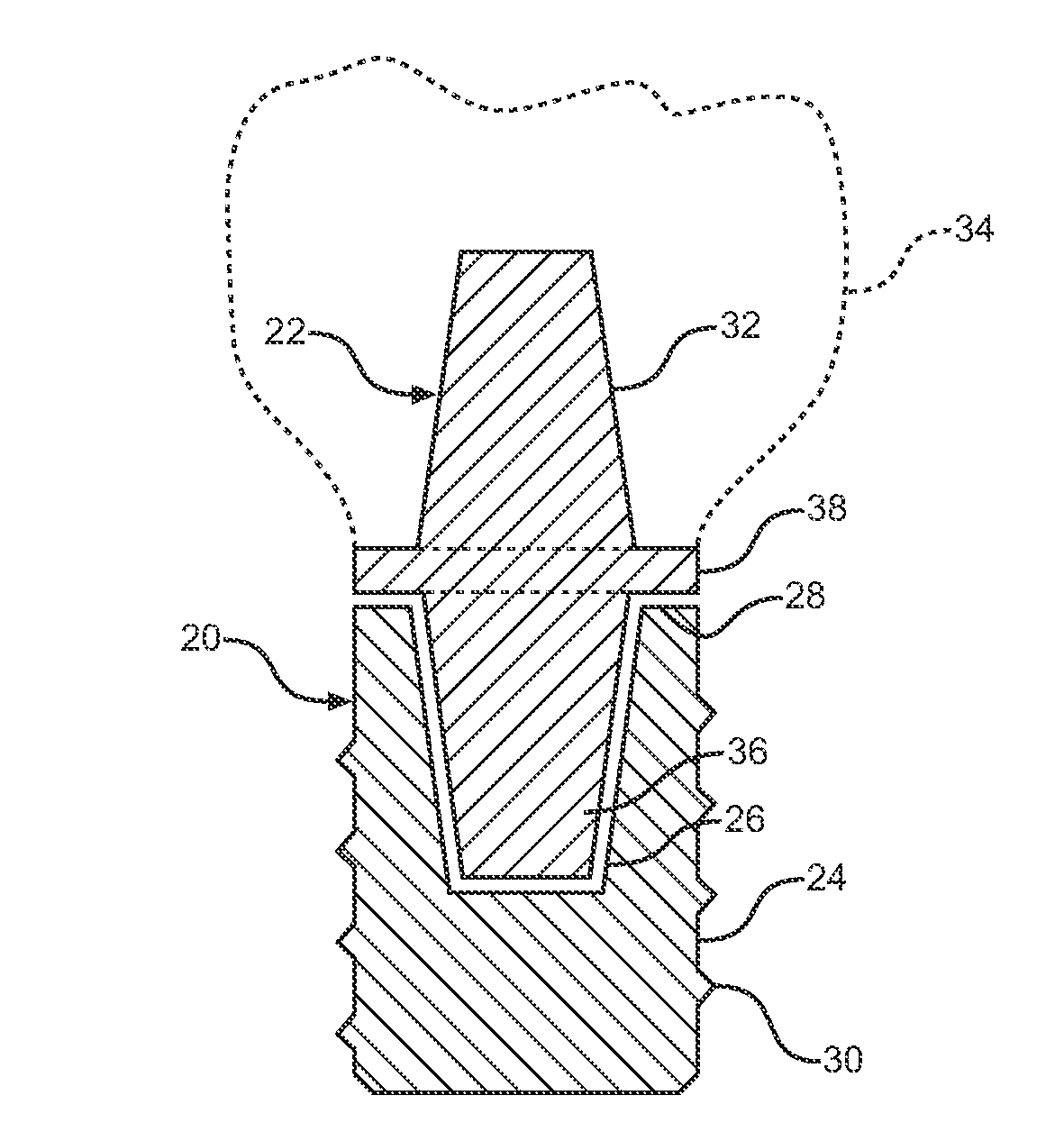 Dental implant system and method of use