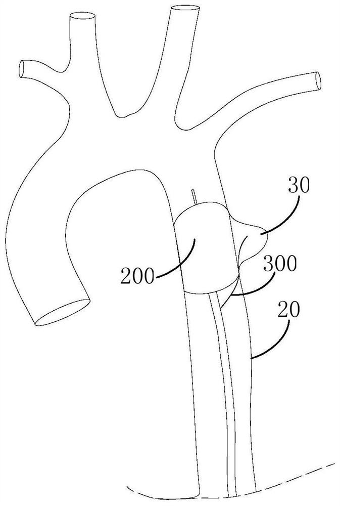 Balloon catheter