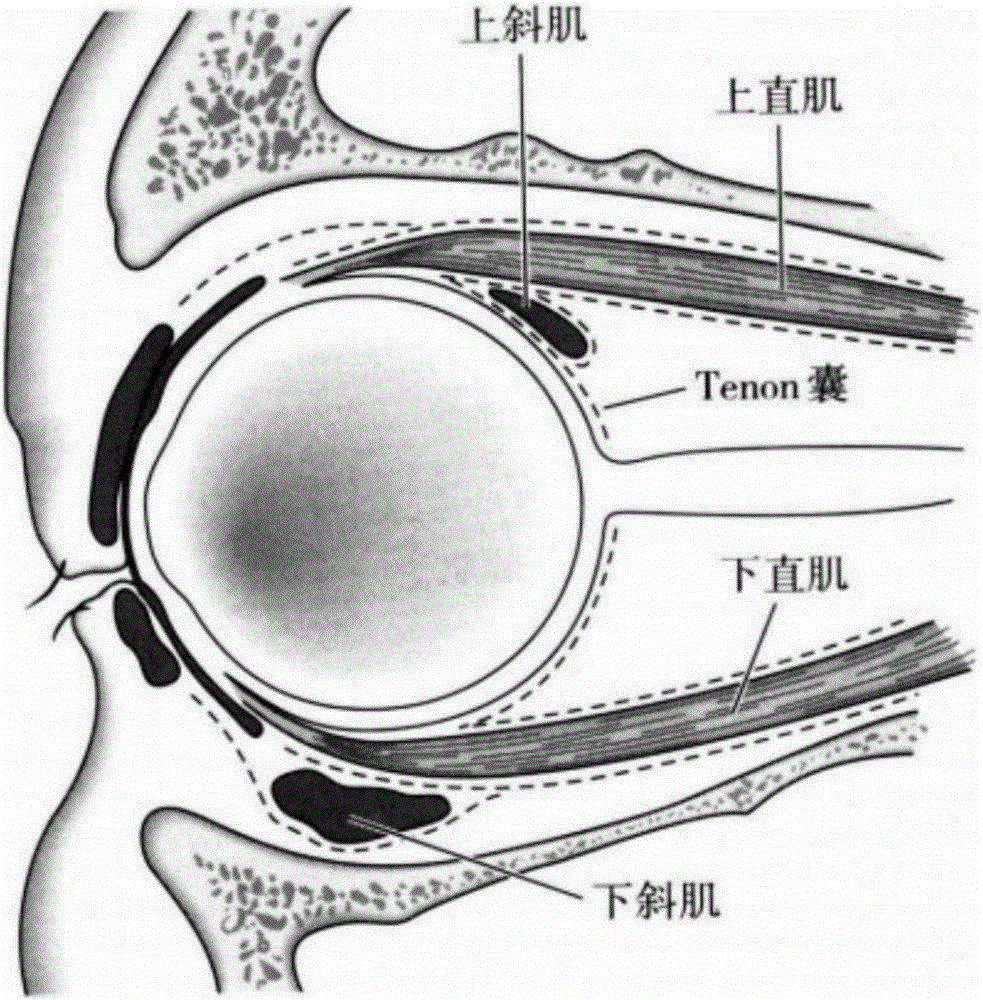 Tenon capsule medicine injection device