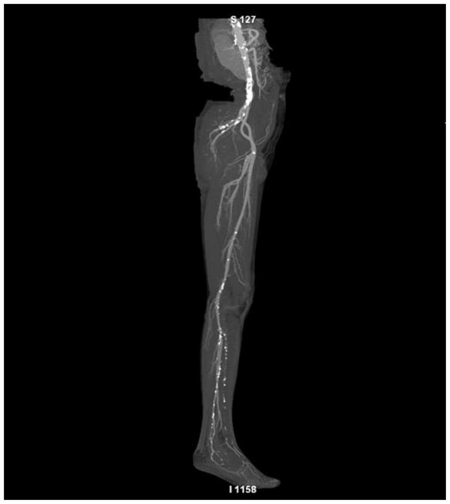 Multi-parameter cumulative calculation method of lower extremity vascular calcification index based on clustering algorithm