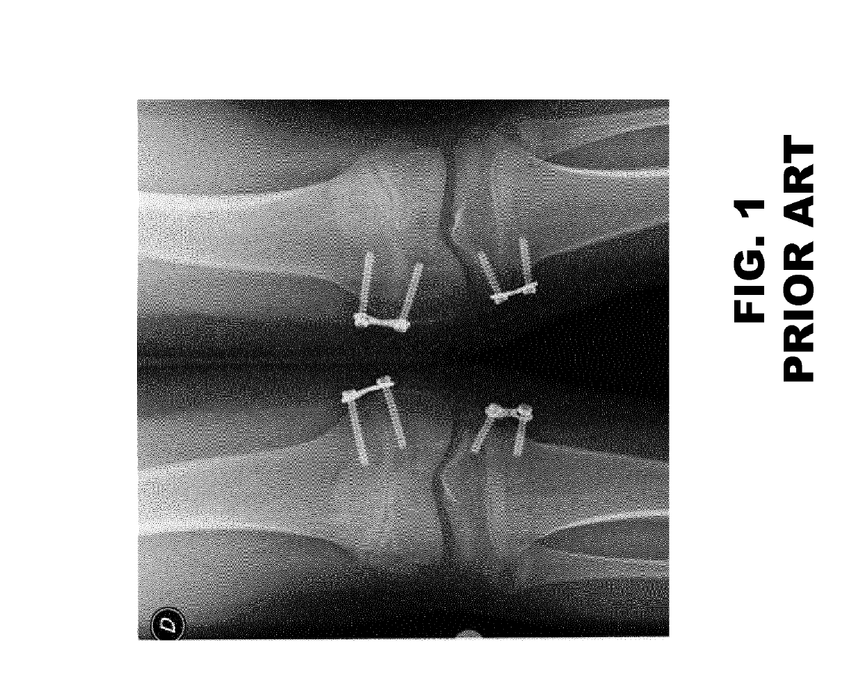 Inner fixation device for the treatment of a limb, in particular the femur distal portion or tibia proximal portion