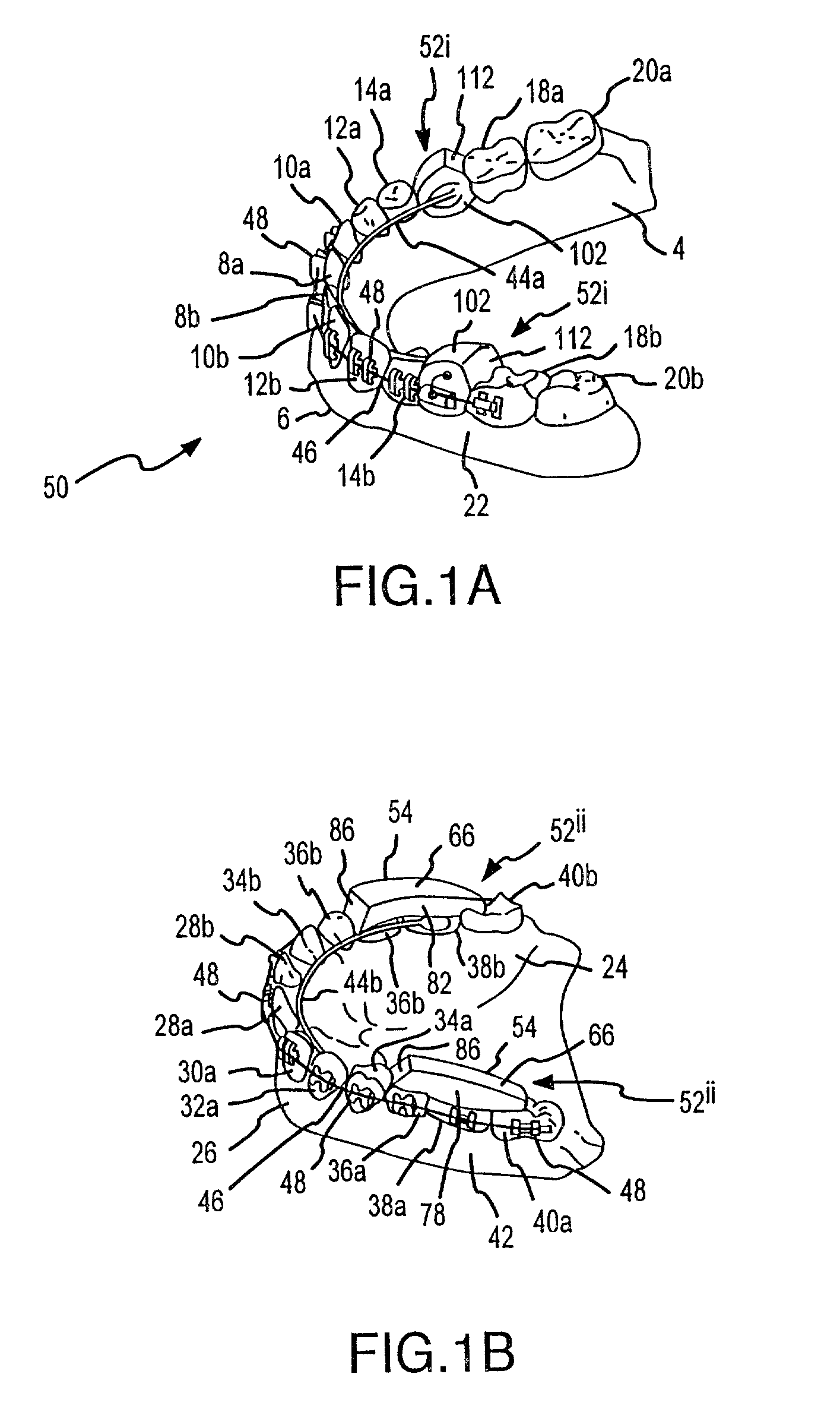 Mandibular advancer and method of installing the same