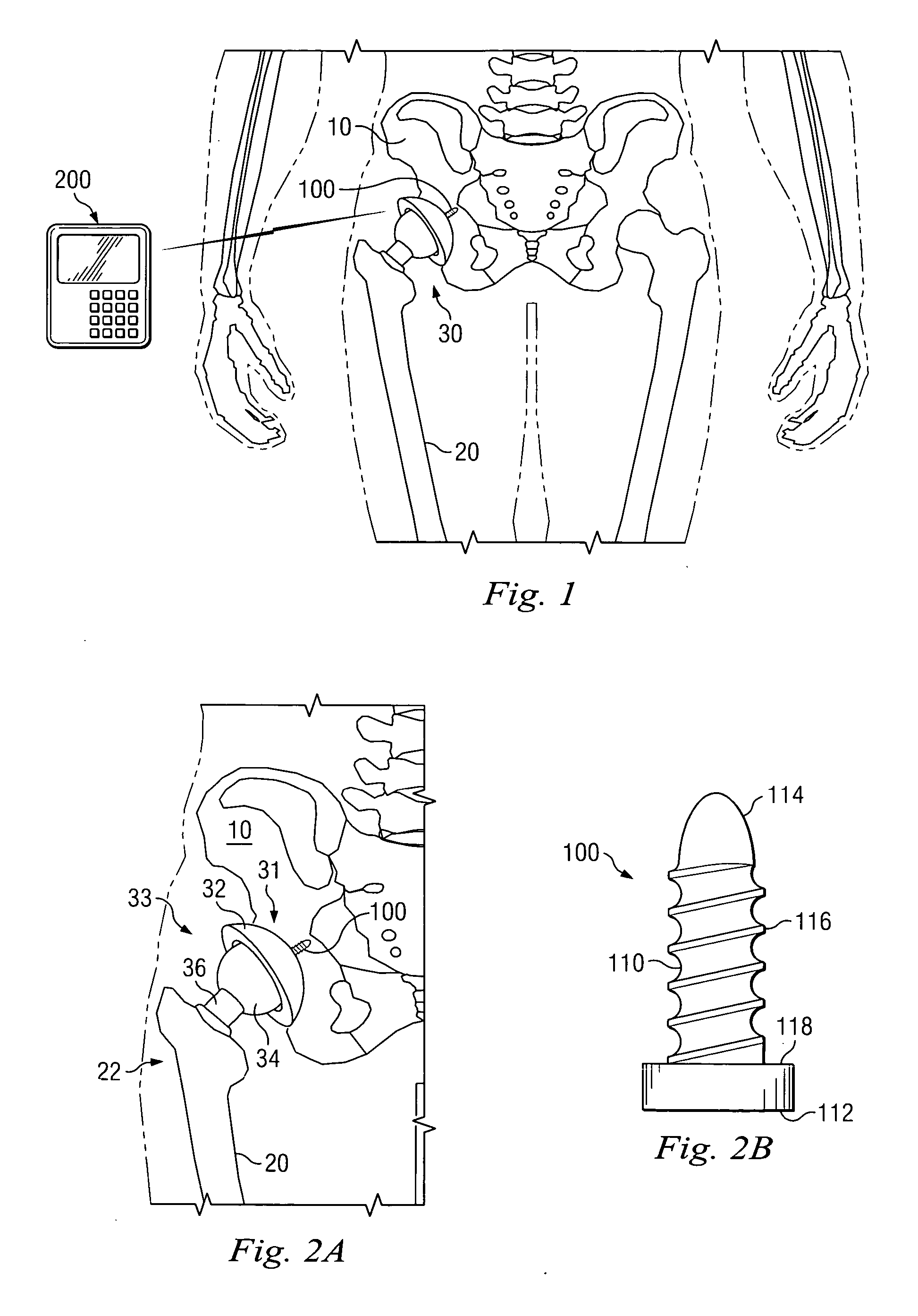 Implantable pedometer