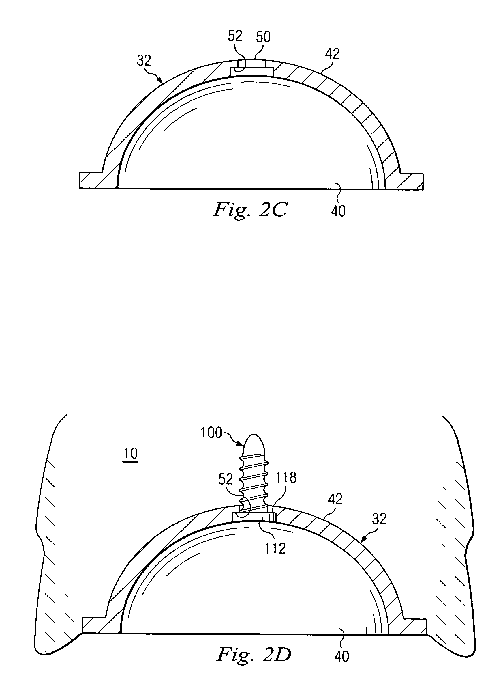 Implantable pedometer