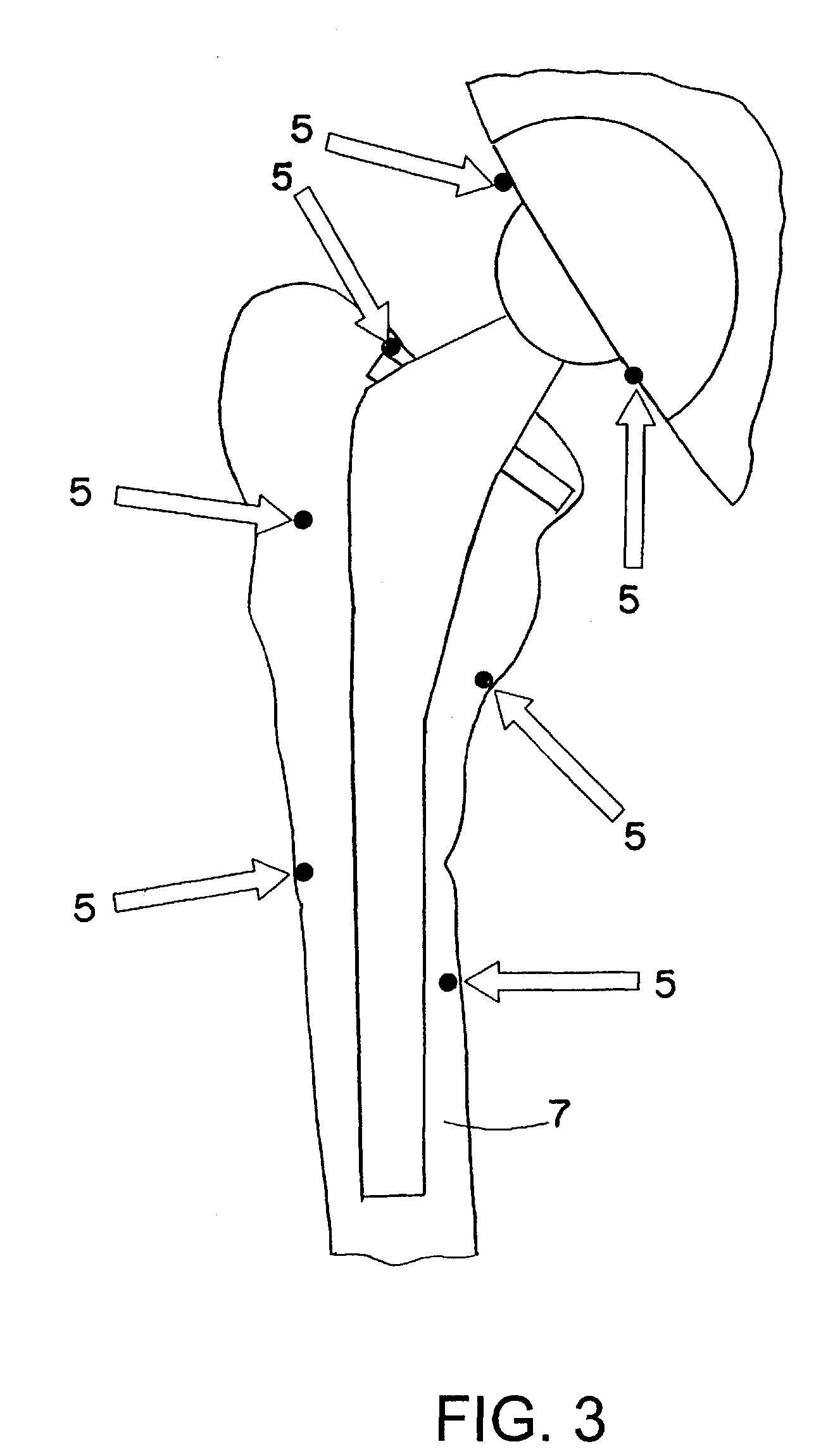 Method and device for registering an anatomical structure using markers