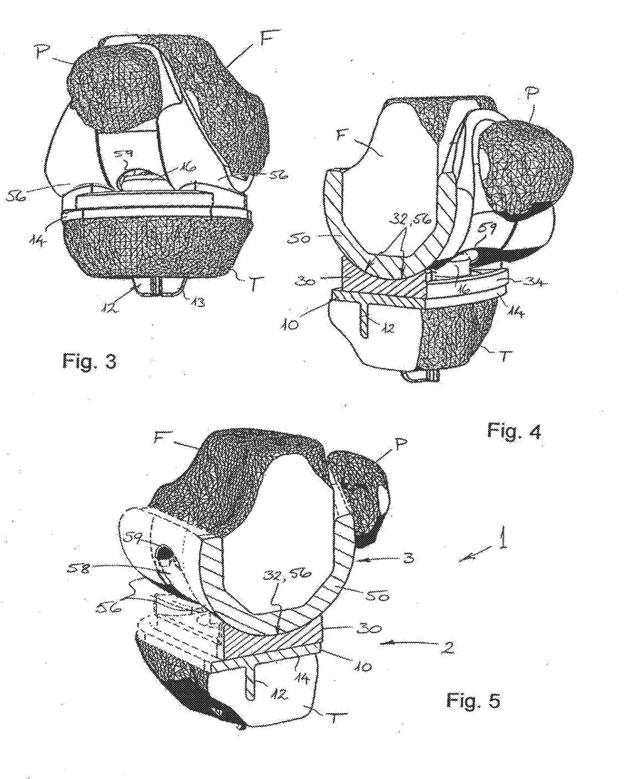 Knee Joint Prosthesis and Related Method