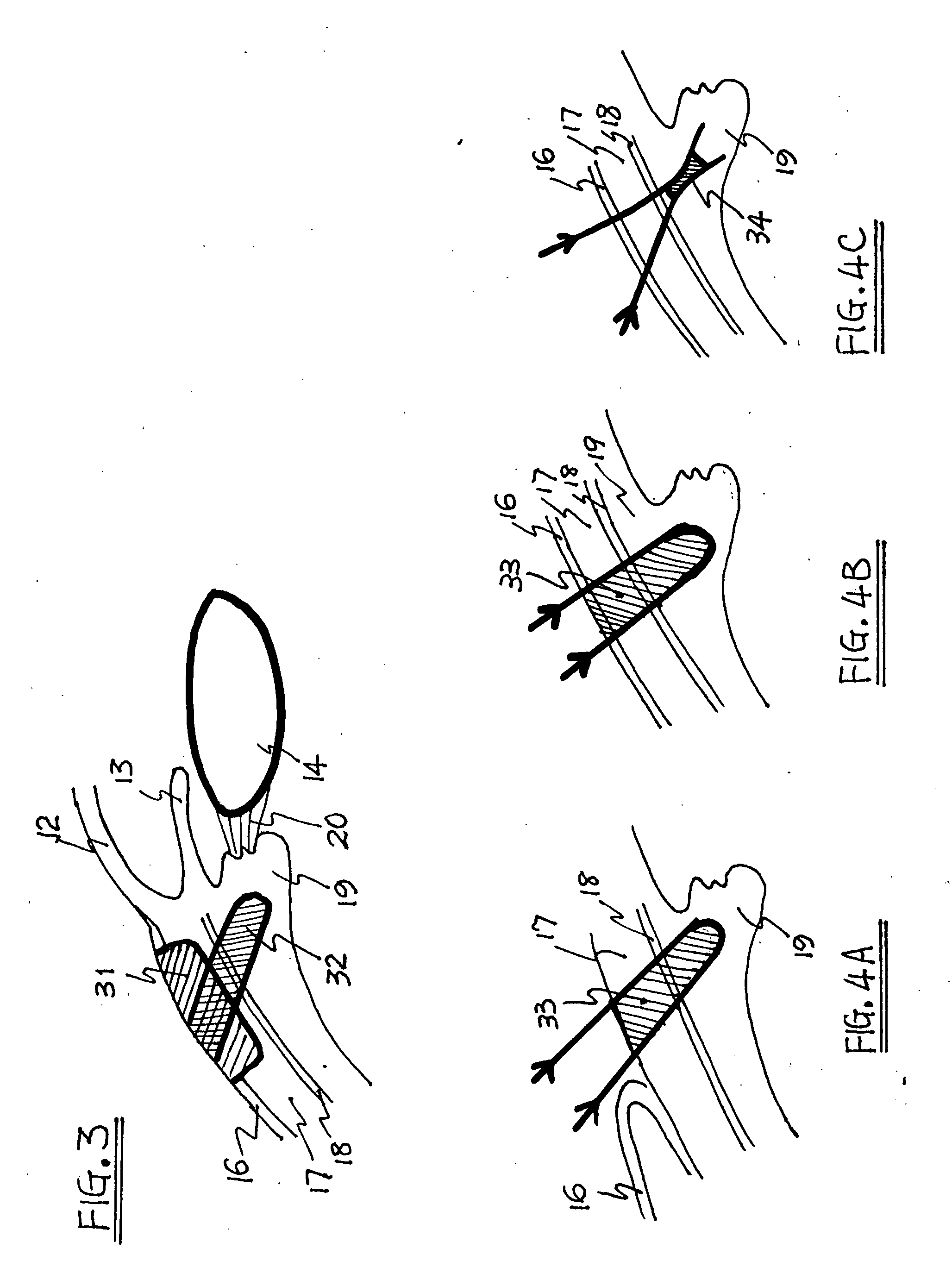 Method and apparatus for the treatment of presbyopia and glaucoma by ciliary body ablation