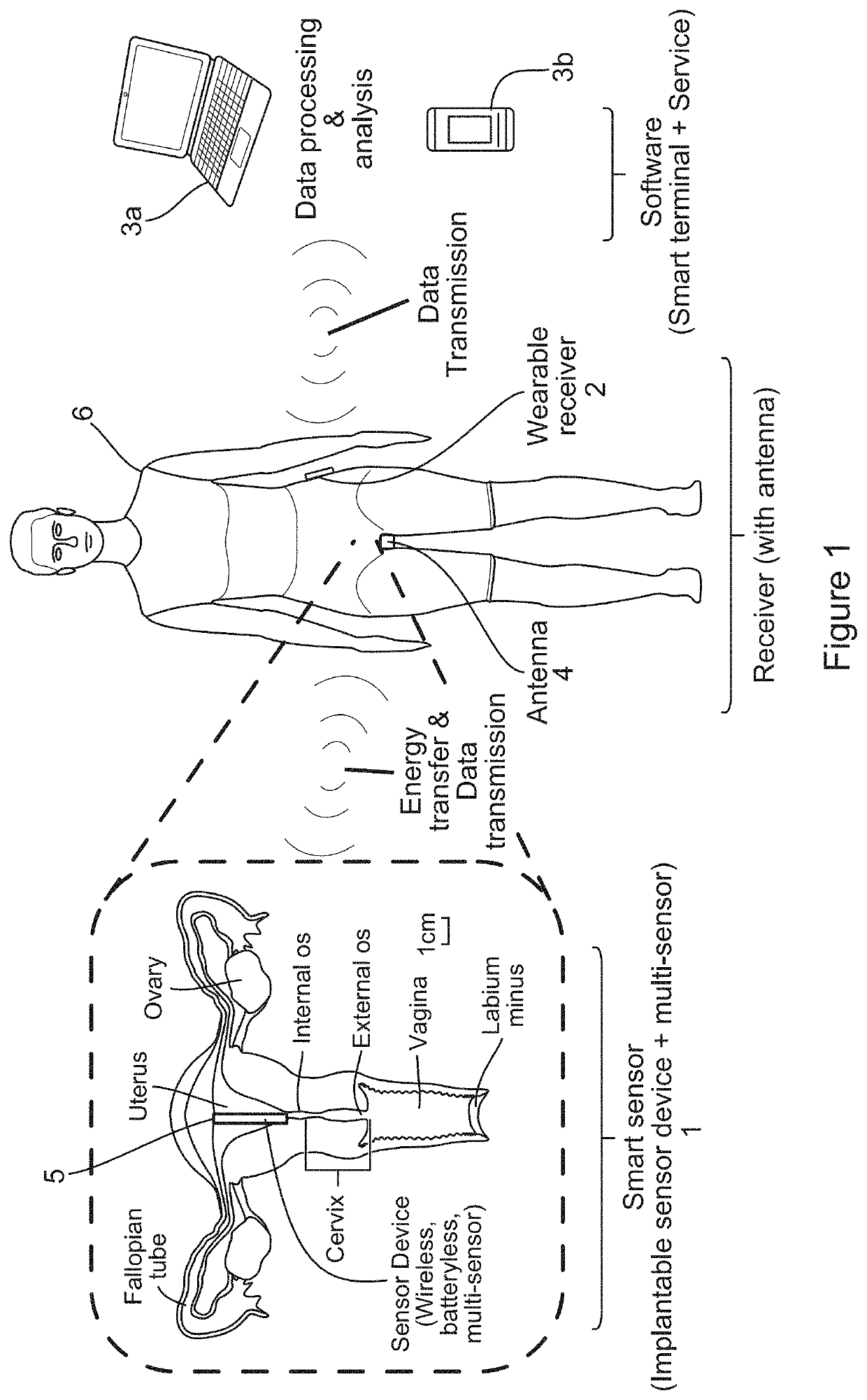 Intra-uterine monitoring system