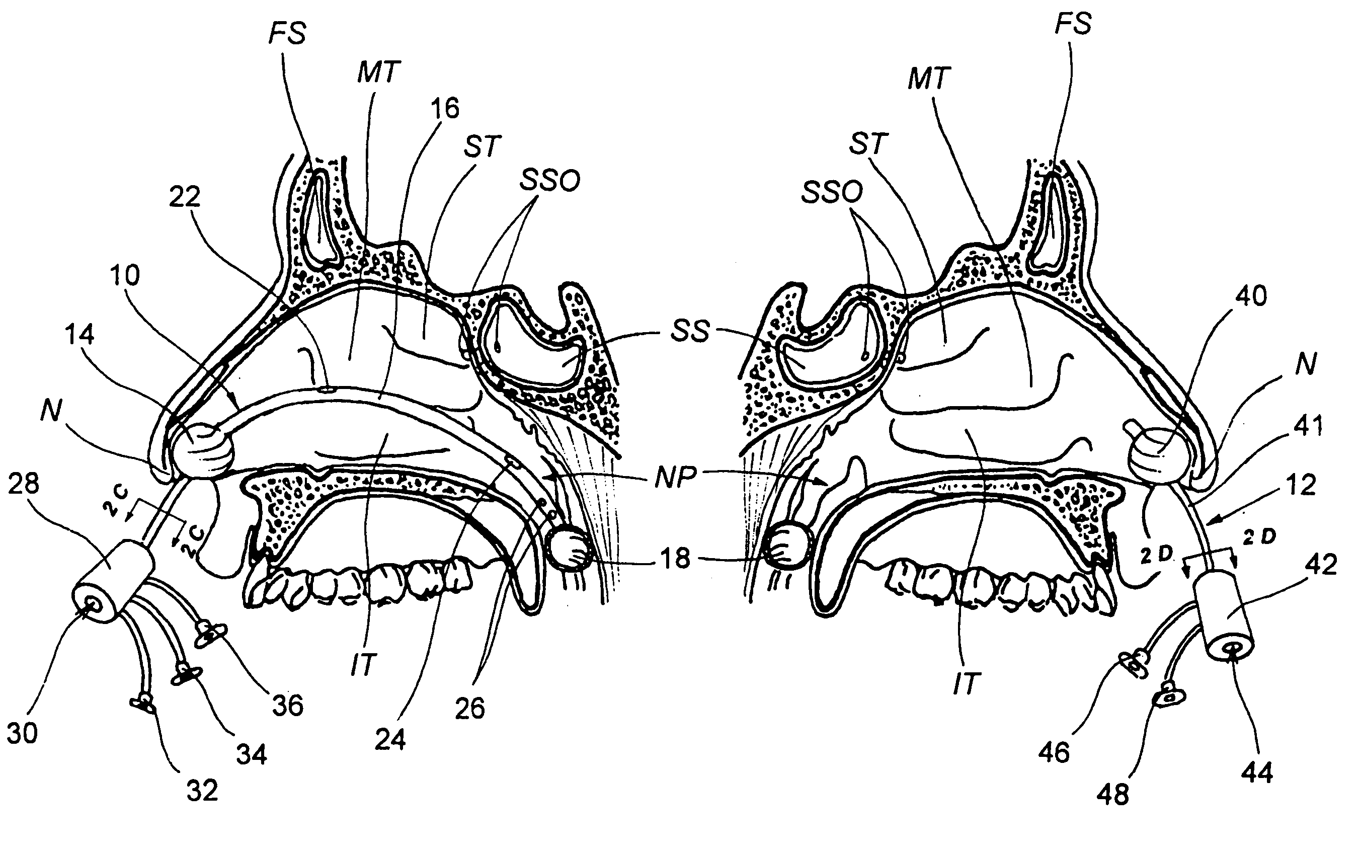 Devices, systems and methods for diagnosing and treating sinusitus and other disorders of the ears, nose and/or throat