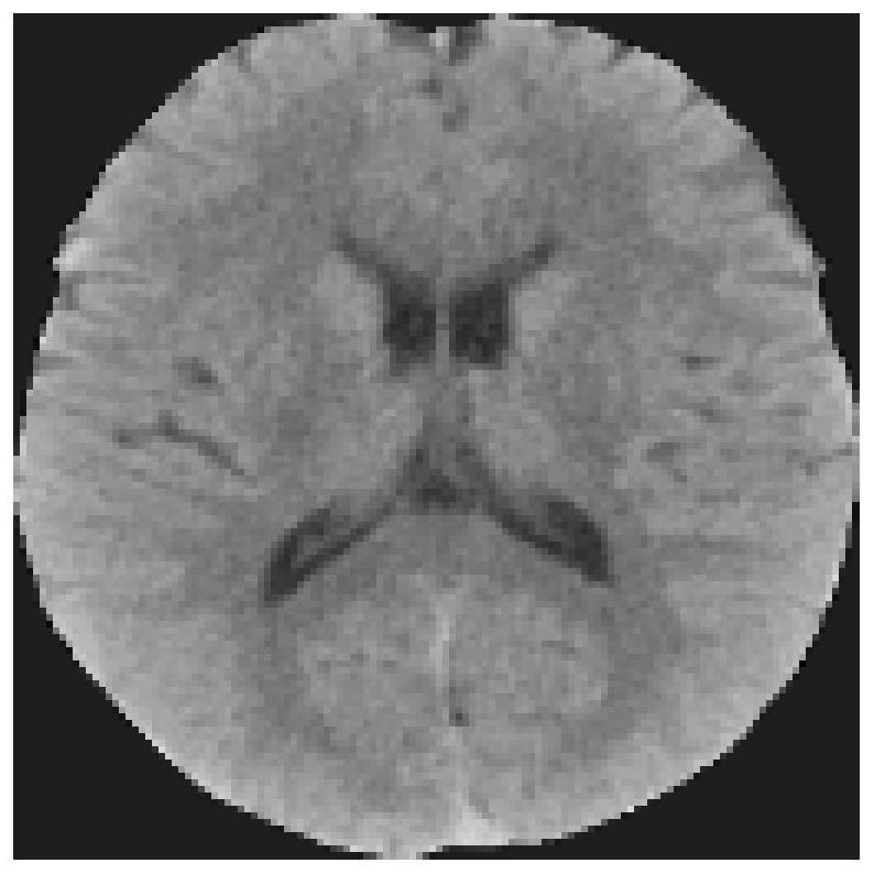 Automatic ASPECTS scoring method based on plain-scan CT, computer equipment, readable storage medium and program product