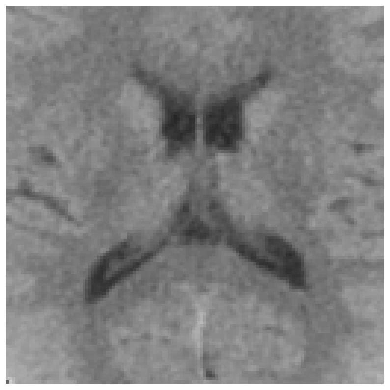 Automatic ASPECTS scoring method based on plain-scan CT, computer equipment, readable storage medium and program product