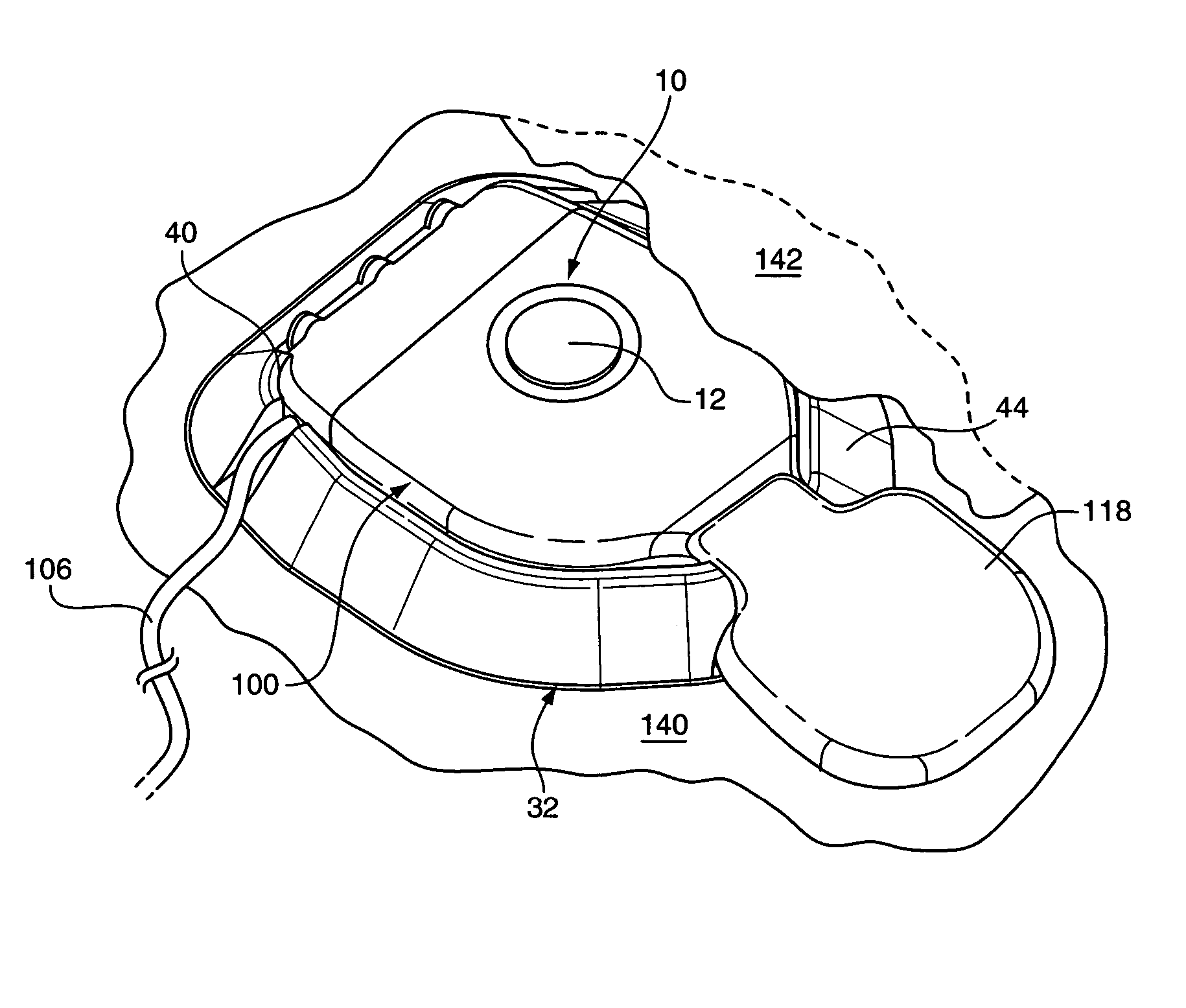 Passive vibration isolation of implanted microphone