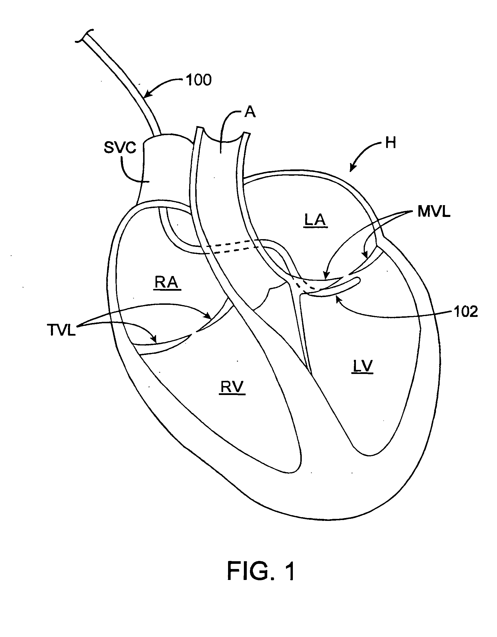 Delivery devices and methods for heart valve repair