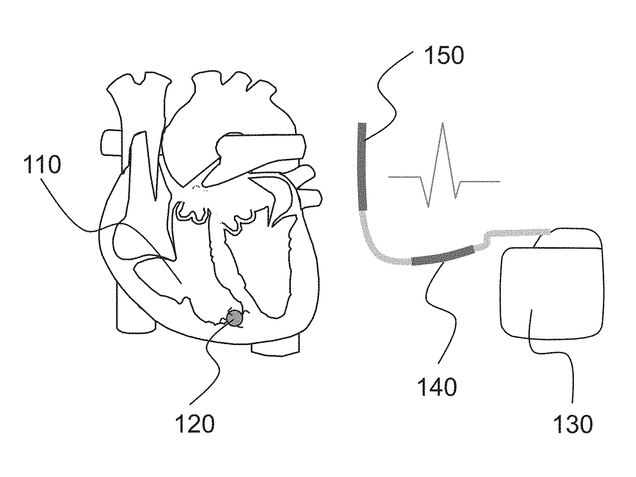 Implantable cardiac system having an r-spike amplifier