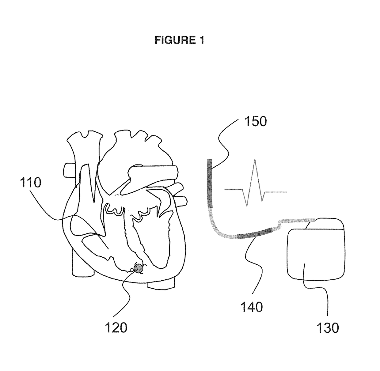 Implantable cardiac system having an r-spike amplifier