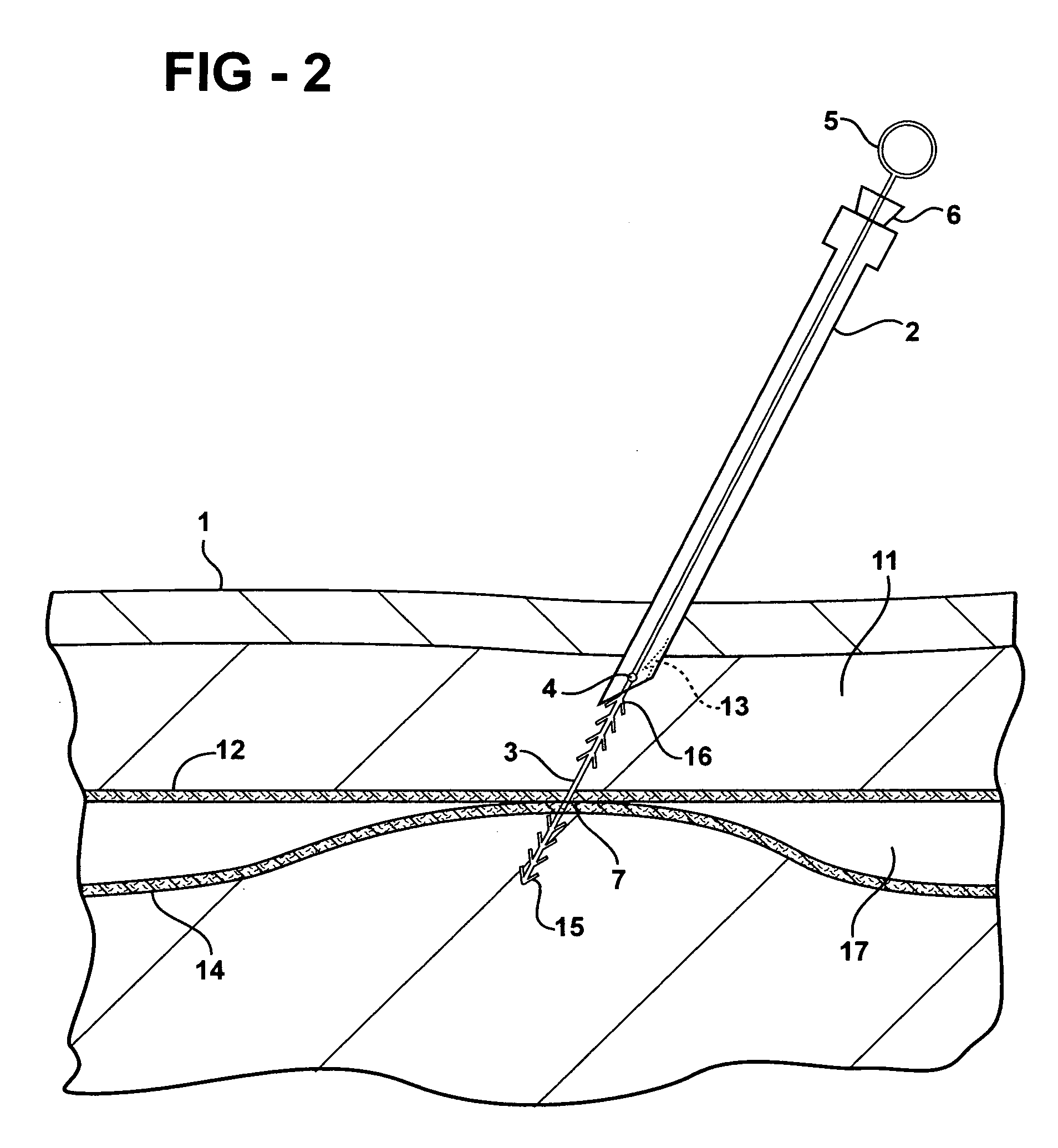 Methods and apparatus for utilization of barbed sutures in human tissue including a method for eliminating or improving blood flow in veins