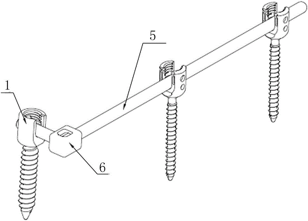 Semi-opened and semi-closed spine ilium bolt