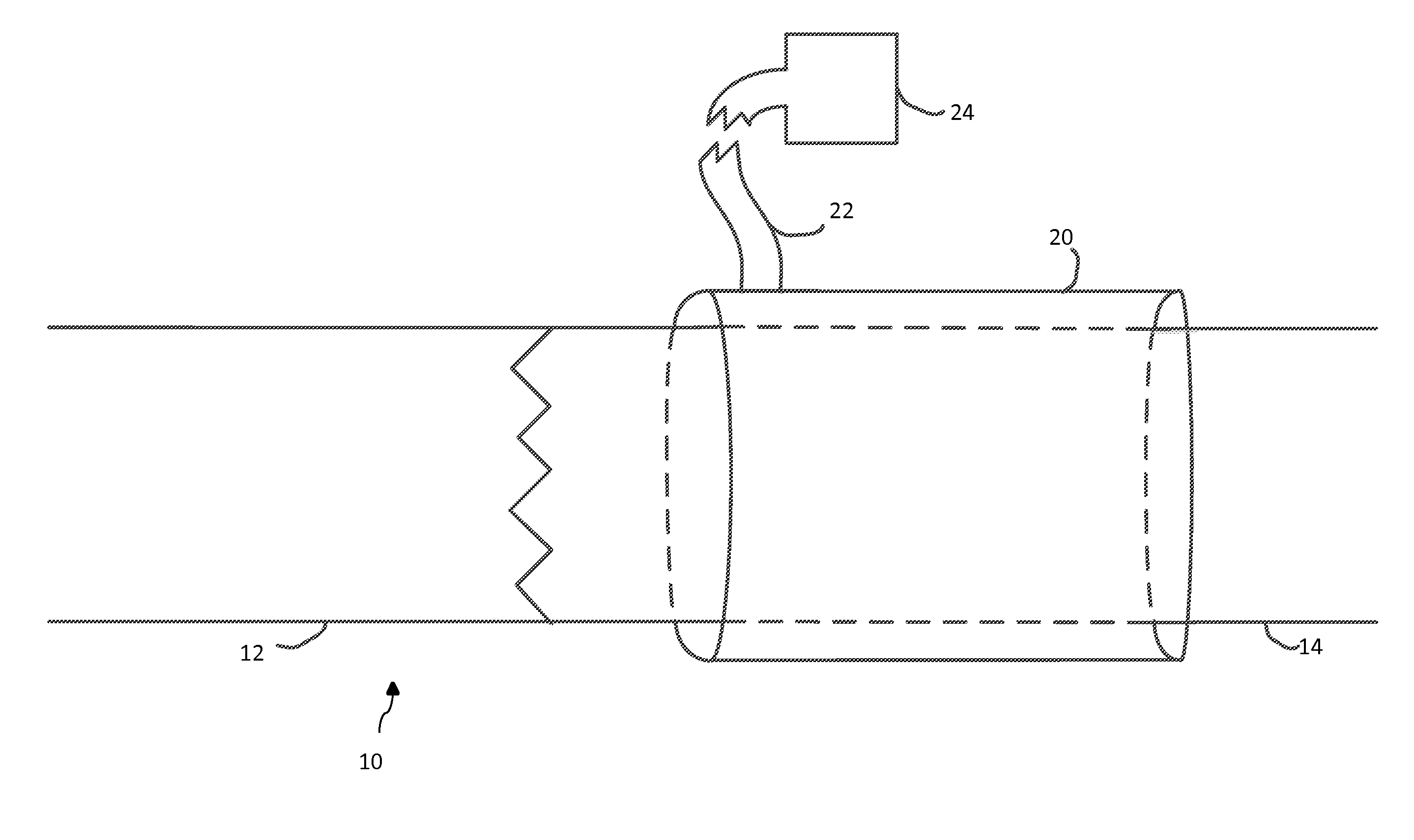 Methods and materials for reducing venous stenosis formation of an arteriovenous fistula or graft