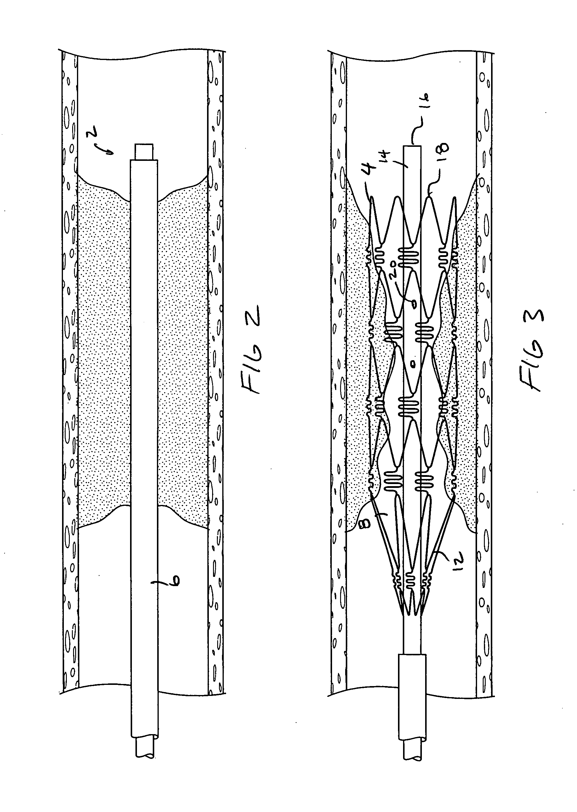 Devices and methods for temporarily opening a blood vessel