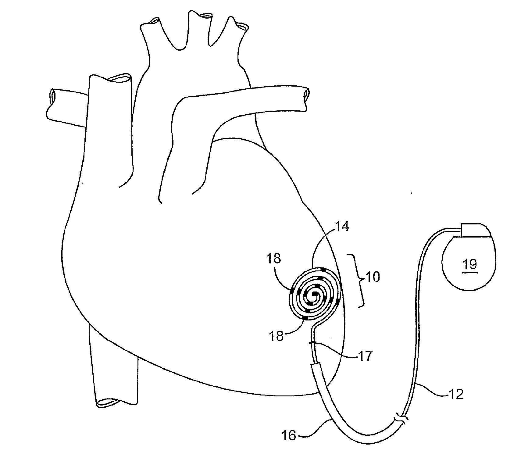 Deployable epicardial electrode and sensor array