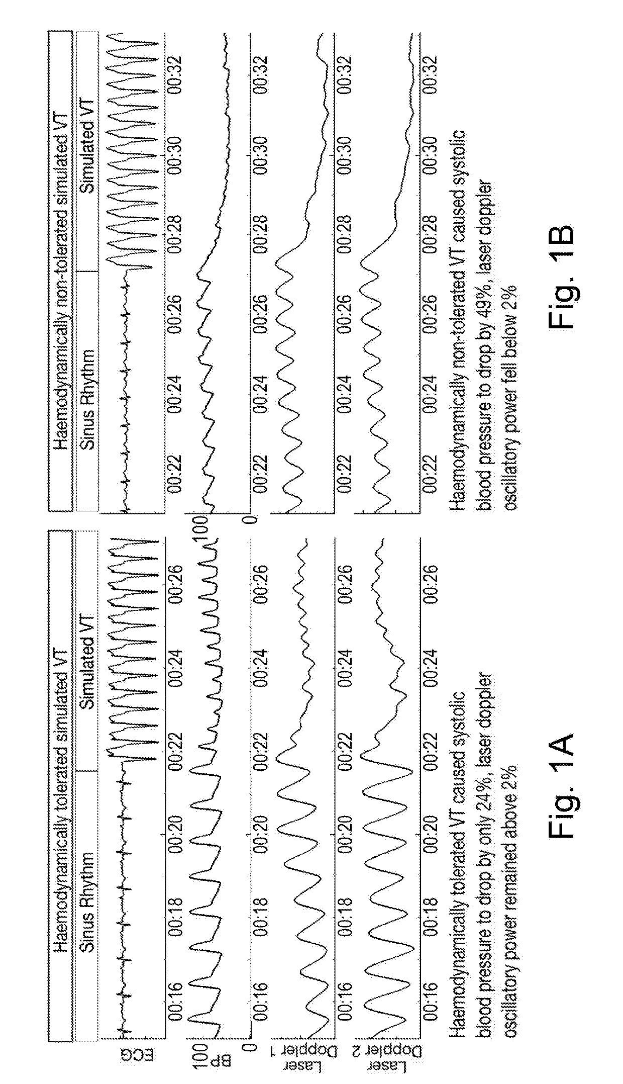 Method and an apparatus for determining haemodynamic status