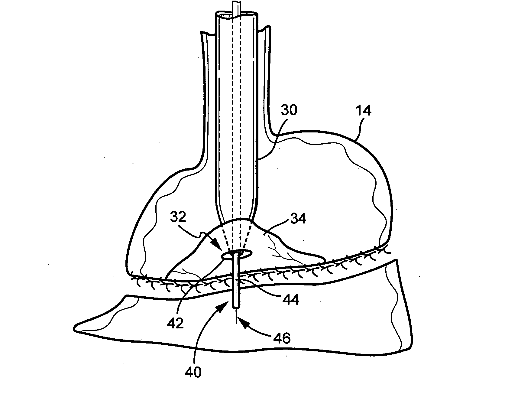 Kit and method for EEA anvil placement in bariatric surgery