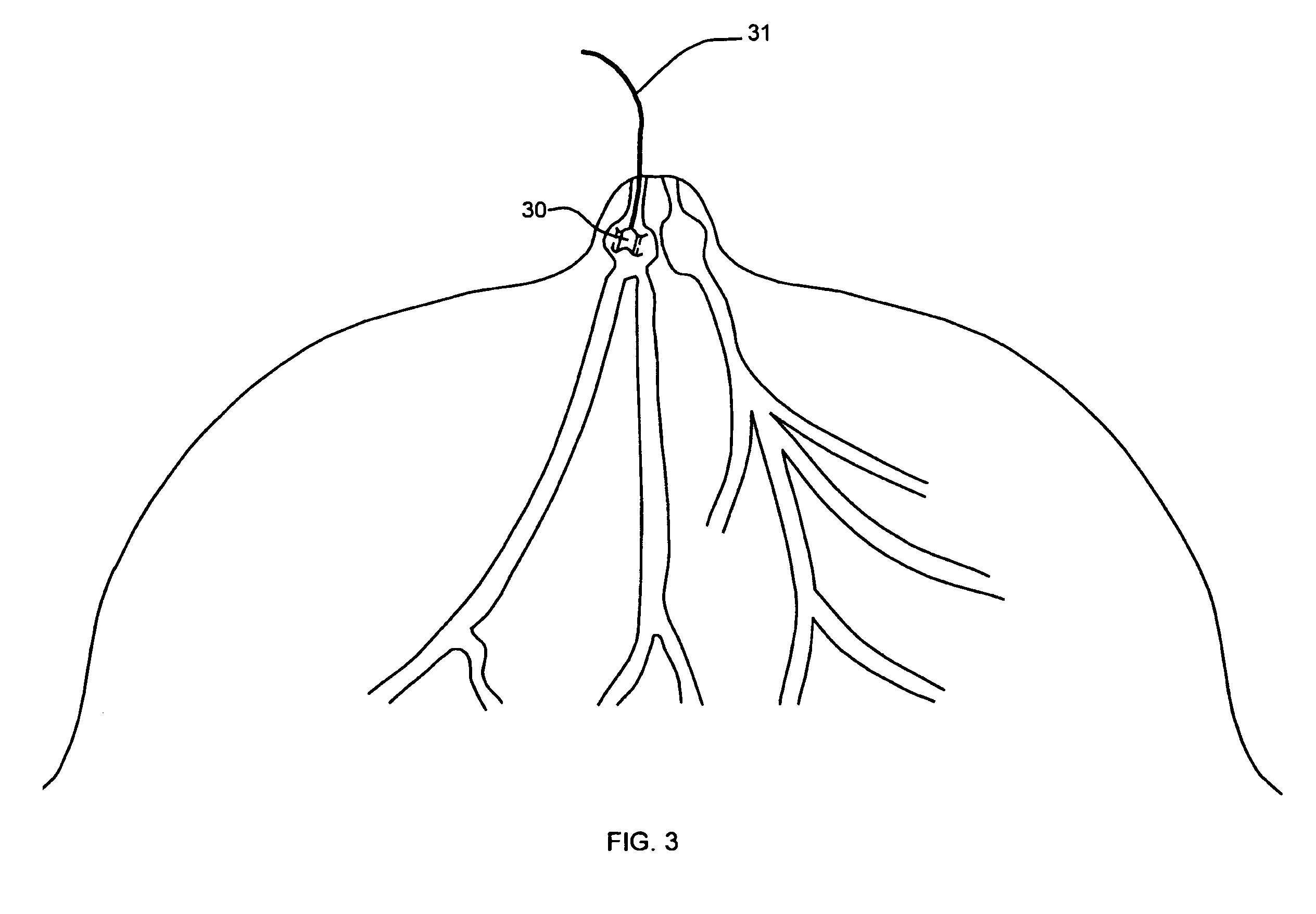 Methods and devices for delivery of agents to breast milk ducts