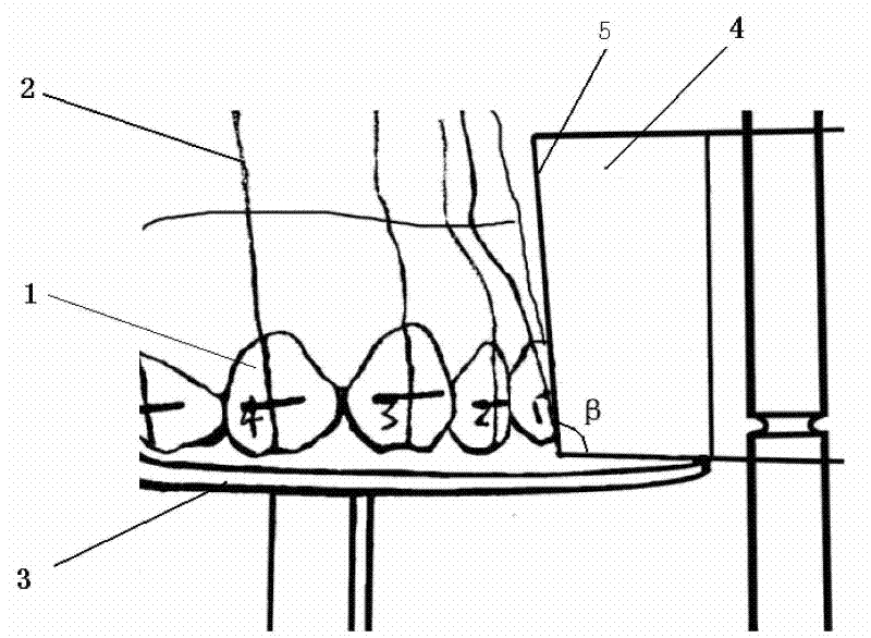 Method for manufacturing personalized tongue side corrector and tongue side corrector