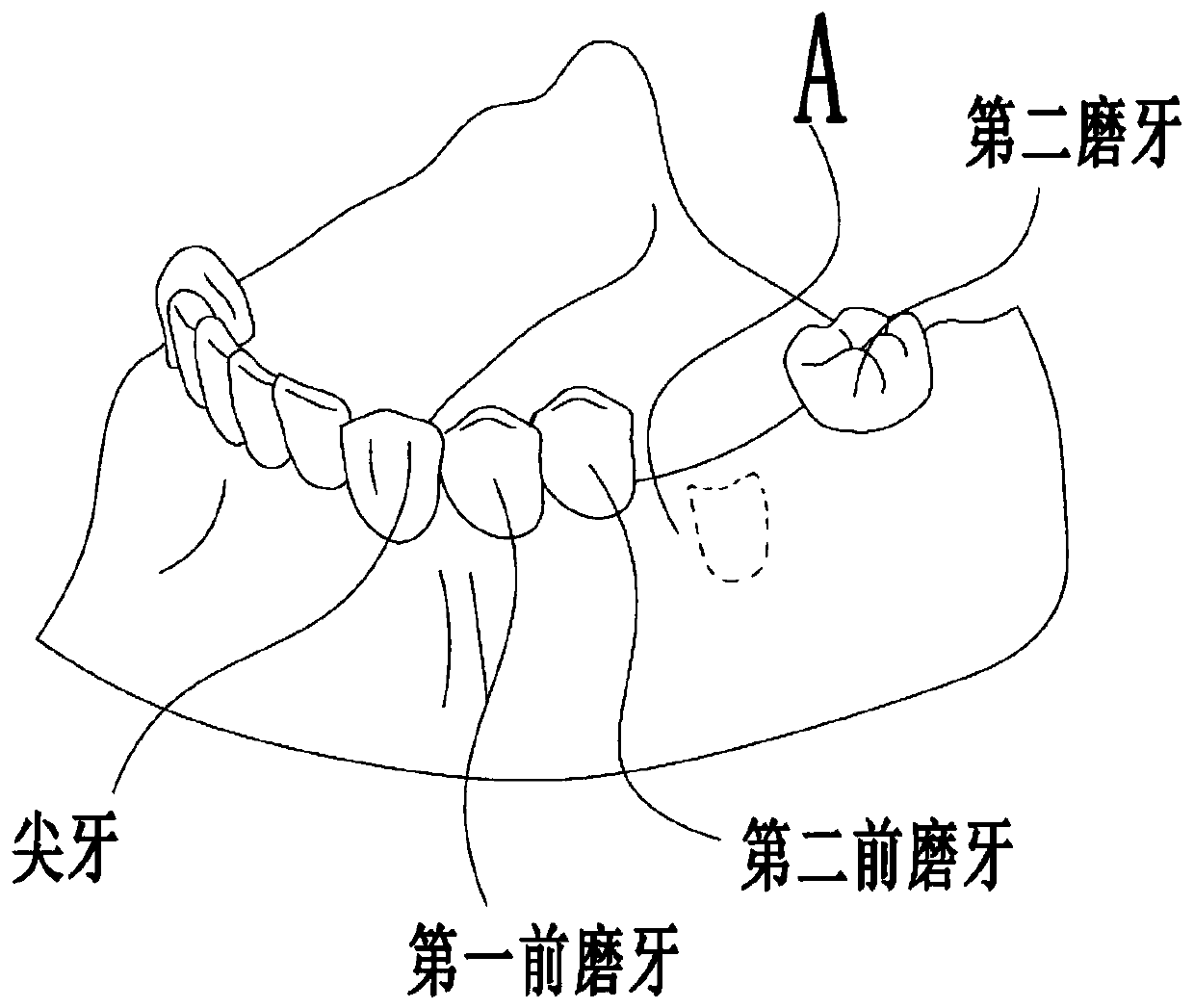 Positioning device and method for second-stage operation of oral implantation