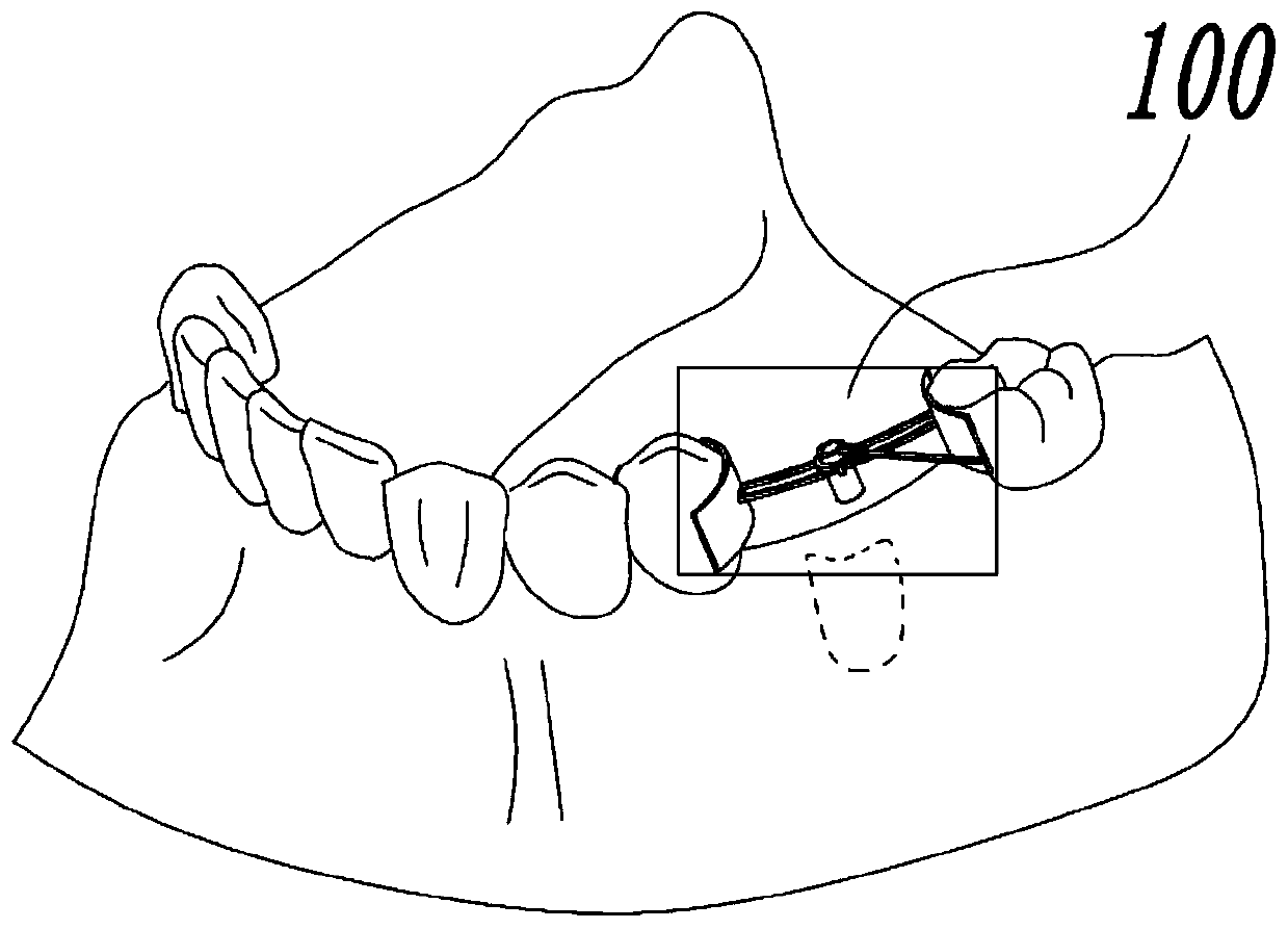 Positioning device and method for second-stage operation of oral implantation