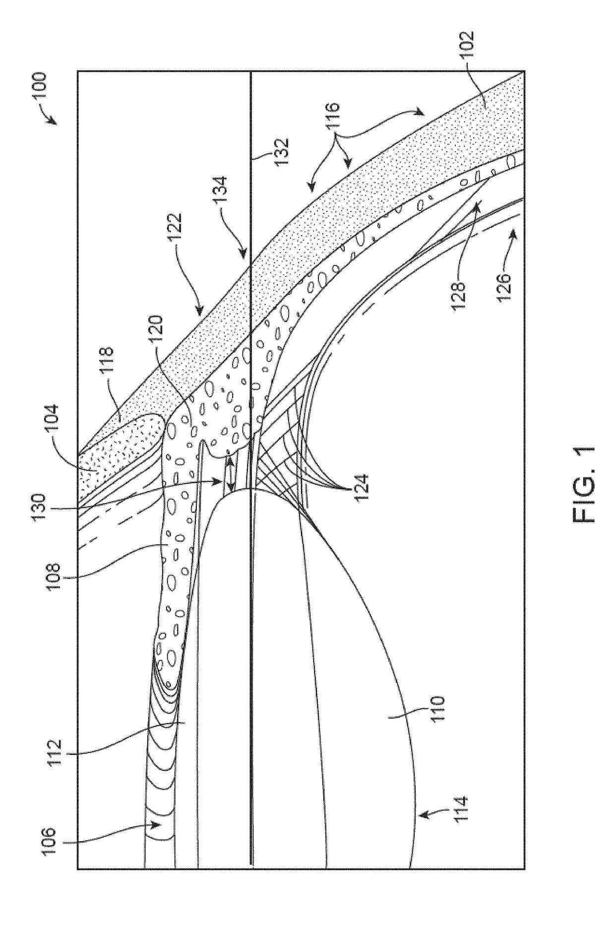 Glaucoma treatment  methods and apparatus