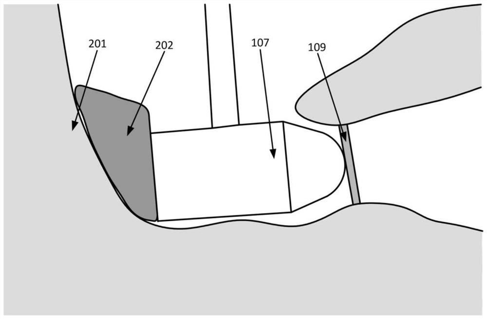 A fixed bracket for a circular window-excited vibration type artificial middle ear actuator