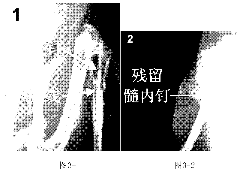 Absorbable metal intramedullary nail and preparation method thereof